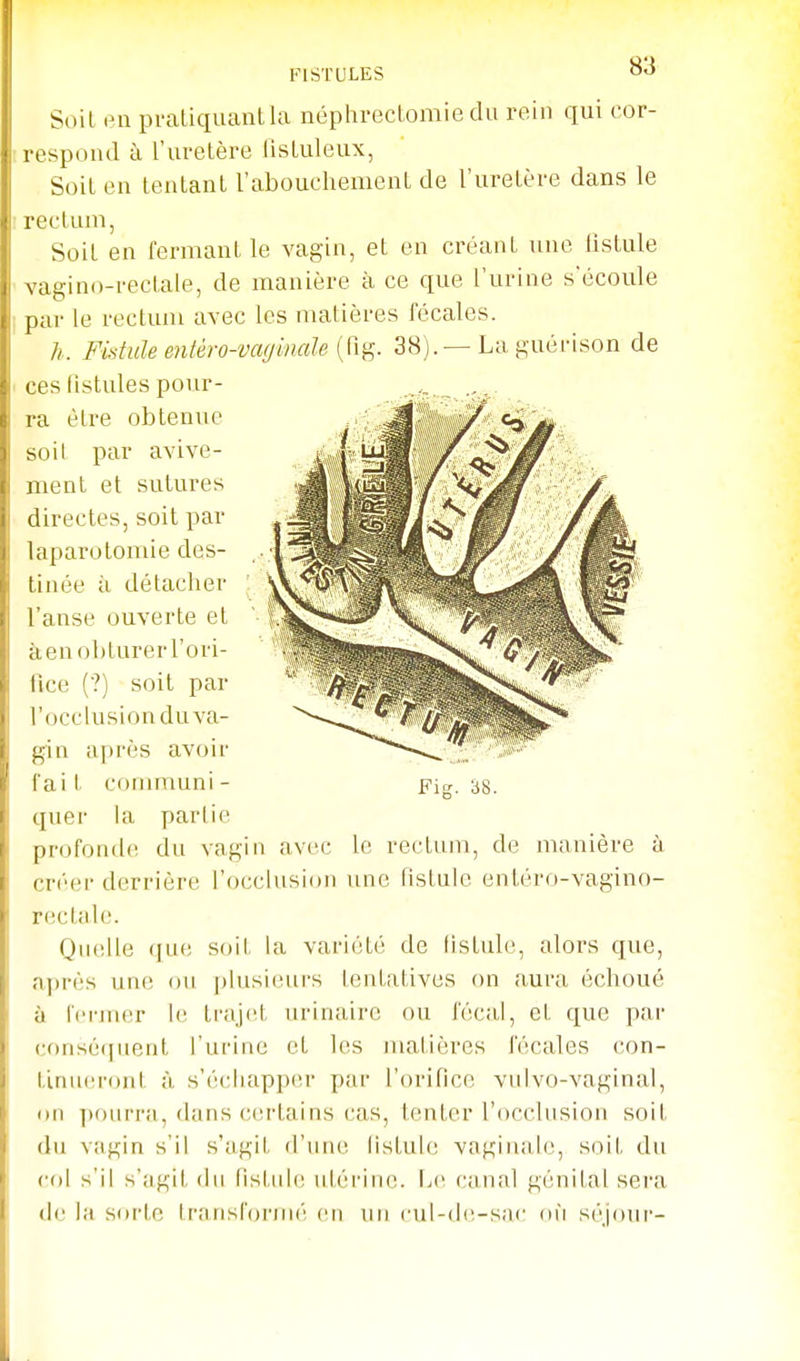 Soil en pi'aliquauUu néphrecLomie du rein qui cor- respond à l'uretère lisluleux, Soil en tentanl l'abouchement de l'uretère dans le I rectum, Soil en fermant le vagin, et en créant une lislule • vagino-rectaie, de manière à ce que l'urine s'écoule I par le rectum avec les matières fécales. h. Fistule entéro-vagmaie {'à^. 38).—La guérison de . ces fistules pour- ra être obtenue soit par avive- ment et sutures directes, soit par laparotomie des- tinée à détacher l'anse ouverte et àen obturer l'ori- fice (?) soit par l'occlusion du va- gin après avoir fait conimuni- Fig. 38. quer la partie profonde du vagin avec le rectum, de manière à créer derrière l'occlusion une tislulc entéro-vagino- rectale. Quelle (jue soit la variété de lislule, alors que, après une ou plusieurs lentalives on aura échoué à l'erjucu- l(^ ti'ajet urinairc ou fécal, et que par eonsé(|iienl l'urine et les nialières fécales con- tlnu(!r()nt à s'échapper par l'orifice vulvo-vaginal, un ])ourra, dans certains cas, tenter l'occlusion soil du vagin s'il s'agit (rnn(i listuli! vnginale, soil. du col s'il s'agit (In fistnl(! ntérin(!. Le canal génital sera d(ï la soi'tc transl'ornK'^ en un cul-de-sac on séjour-