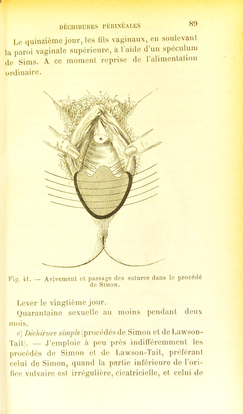 1 DÉCHIRURES PKRINÉALES Le quinzième joui-, les tils vaginaux, en soulevant, la paroi vaginale supérieure, à l'aide d'un spéculum de Sims. A. ce momenl reprise de ralimenlalion ordinaire. Kirr. 41. _ Avivement et passage des sutures dans le procédé de Simon. Lever le vingtième jour. Quarantaine sexuelle au moins pendant deux iiKiis. r) Déchirure simple (procédés de Simon et de Lawson- 'l'aitl. - - .l'emploie à pou ])rès indineremment les procédés do Simon et de Lawson-Tail, pt'éféranl celui de Simon, quand la partie inférieure de l'ori- fice vulvaire est irrégulière, cicatricielle, et celui de