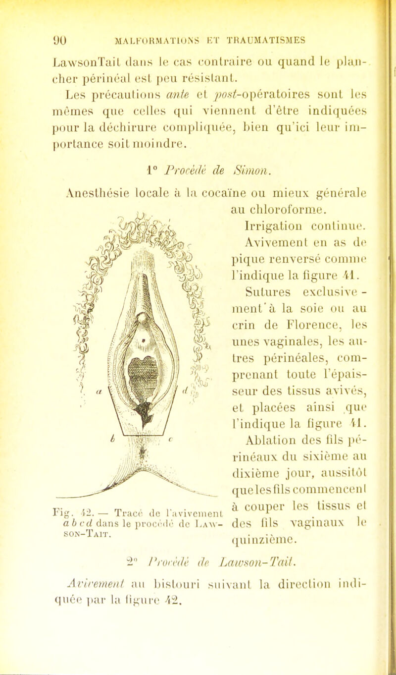LawsonTail dans le cas contraire ou quand le plan- cher périnéal esL peu résisLanL. Les précaulioiis ante el jjos^-opératoires sont les mêmes que celles qui viennent d'être indiquées pour la déchirure compliquée, bien qu'ici leur im- portance soit moindre. 1° Procéilé de Simon. ÂnesLhésie locale à la cocaïne ou mieux générale au chloroforme. Irrigation continue. Avivement en as de pique renversé comiiu' l'indique la figure il. Sutures exclusive - ment'à la soie ou au crin de Florence, les unes A'aginales, les au- tres périnéales, com- prenant toute l'épais- seur des tissus avivés, et placées ainsi que l'indique la figure il. Ablation des fils pé- rinéaux du sixième au dixième jour, aussitôt que les fils commencen I à couper les tissus el des nis vaginaux h- (luinzième. Fig. 'li.— Tracr ilc l'avivcinenl abcd dans le ])roi;(''(l(' de I.aw- sOiN-Tait. i Pron'tlè (h Lawson-Taii. Aviremeiil au bishuiri suivant la direction indi- (Iiié(> (lar la li.mii'c /ii>.