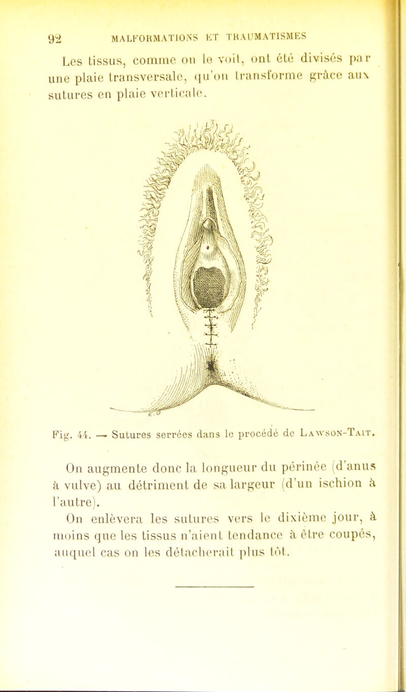 Les tissus, comme on lo voit, onl été divisés par une plaie transversale, <iu'()ii transforme grâce aux sutures en plaie verticale. Fig. -14. — Sutures serrées dans lo procédé de Lawson-Tait, On augmente donc la longueur du périnée (d'anus k vulve) au détriment de sa largeur (d'un ischion à l'autre). On enlèvera les sutures vers le dixième jour, à moins que les tissus n'aient tendance à être coupés, auquel cas on les détaclierail plus loi.