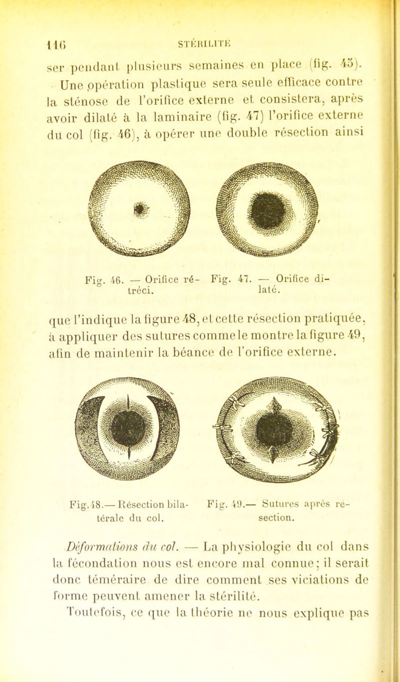 ser peiidanL plusieurs semaines en place (fig. 45). Une .opération plastique sera seule efficace contre la sténose de l'orifice externe et consistera, après avoir dilaté à la laminaire (fig. 47) l'orifice externe du col (fig. 46), à opérer une double résection ainsi pio-. 46. — Orifice ré- Fig. 47. — Orifice di- tréci. latc. que l'indique la figure 48, et cette résection pratiquée, à appliquer des sutures comme le montre la figure 49, afin de maintenir la béance de l'orifice exlerne. Fig. 18.— lîésection bila- Fig. t!».— autures après rc- téralc du col. section. Déformations du roi. — La physiologie du col dans la fécondation nous est encore mal connue; il serait donc téméraire de dire comment ses viciations de forme peuvent amener la stérilité. Toutefois, ce que la tliéorie ne nous explique pas