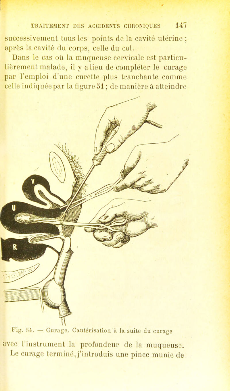 successivement tous les points de la cavité utérine ; après la cavité du corps, celle du col. Dans le cas où la muqueuse cervicale est particu- lièrement malade, il y a lieu de compléter le curage par l'emploi d'une curette plus tranchante comme celle indiquée par la figure 31 ; de manière à atteindre Fig. lii. — Curage. Cautérisation à la suite du curage avec l'instrument la profondeur de la muqueuse. Le curage terminé,j'introduis une pince munie de