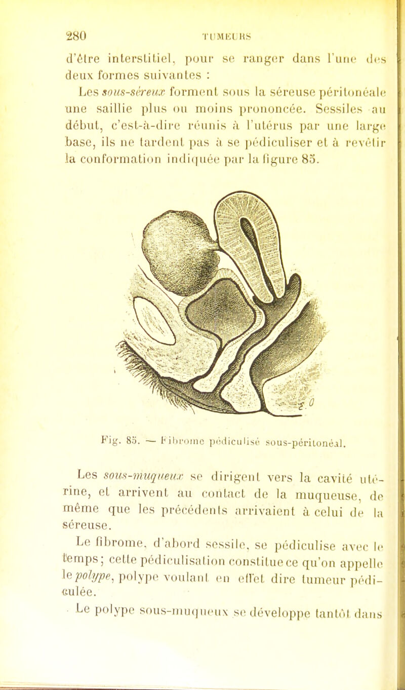 d'élre intersLiliel, pour se ranger dans l'une des deux formes suivantes : Les sous-séreux forment sous la séreuse péritonéale une saillie plus ou moins prononcée. Sessiles au début, c'est-ci-dire réunis à l'utérus par une larj^(! base, ils ne tardent pas à se pédiculiser et à revèlir la conformation indiquée y»ar la ligure 85. Fig. 83. — tiliromc p(!diculist' .sous-périioné.i). Les sous-muqueux se dirigent vers la cavité uté- rine, et arrivent au contact de la muqueuse, de même que les précédents arrivaient à celui de la séreuse. Le fibrome, d'abord sessilo. se pédiculise avec le temps; cette pédiculisation con.stituece qu'on appelle lepolype voulant en edct dire tumeur pédi- culée. Le polype sous-mu(jueu\ se développe lanlôldans