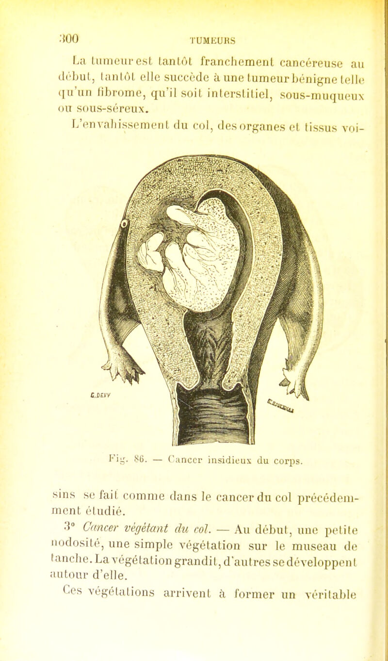 .{00 La luniouresl lanlôl francliemenl cancéreuse au drbul, lanlûL elle succède à une lumeur bénigne lellc qu'un fibrome, qu'il soil inlersUliel, sous-muqueux ou sous-séreux. L'envaliissemenL du col, des organes et tissus voi- sins se fail comme dans le cancer du col précédem- ment étudié. 3° Cancer végétant du col. — Au début, une petite nodosité, une simple végétation sur le museau de tanche. La végétation grandit, d'autres se développent autour d'elle. Ces végétations arrivent à former un véritable