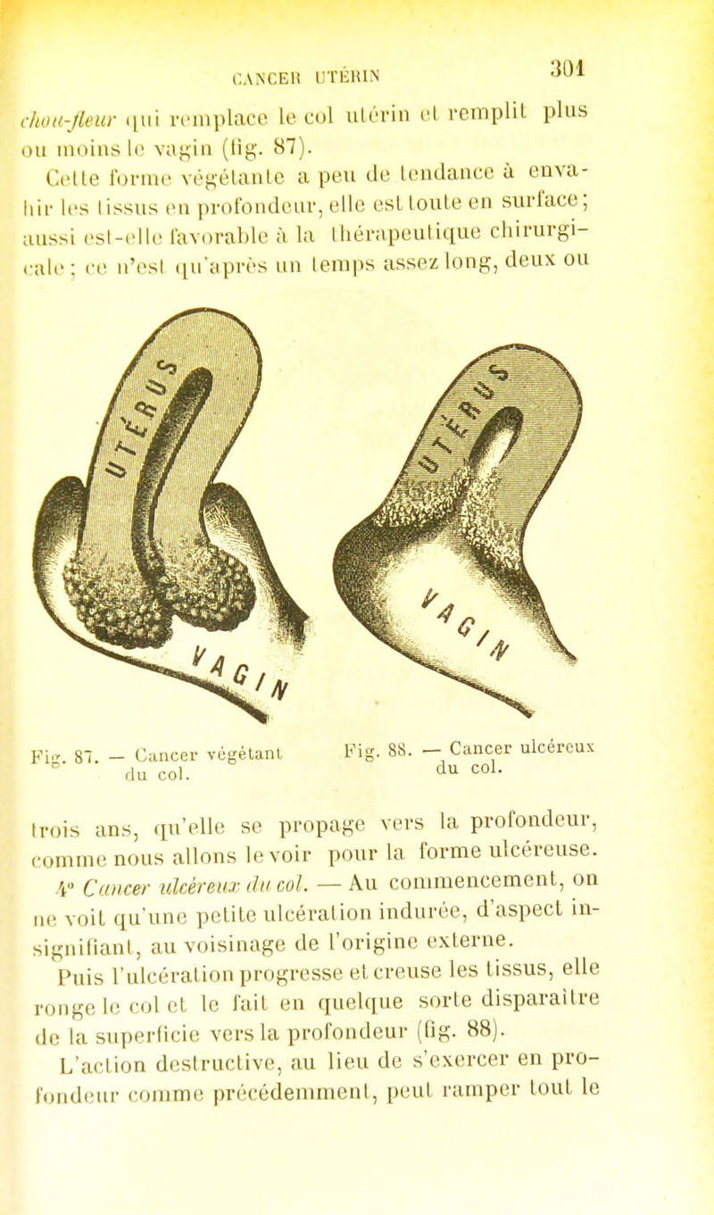 CANCER UTÉKIN ^Ul chuu-Jleur i[ni remplace le cul ulérin cl remplil plus ou uloius U; vuj^iu (lig. 87). Celle l'orme végélaule a peu de leudaucc à enva- liif les Iissus eu prolbudeuv, elle est loute en surface; aussi est-elle lavorable à la lliérapeutique chirurgi- cale ; ce u'est (Qu'après un lemps assez long, deux ou Fig. 87. — Cancer végétant du col. Fig. 88. _ Cancer ulcéreux ° du col. trois ans, qu'elle se propage vers la profondeur, comme nous allons le voir pour la forme ulcéreuse. i Cancer ulcéreux du col. — Au commencement, on ne voit qu'une petite ulcération indurée, d'aspect in- signifiant, au voisinage de l'origine externe. Puis l'ulcération progresse et creuse les tissus, elle ronge le col et le fait en quelque sorte disparaître de la superficie vers la profondeur (fig. 88). L'action destructive, au lieu de s'exercer en pro- fondeur comme précédemment, peut ramper tout le