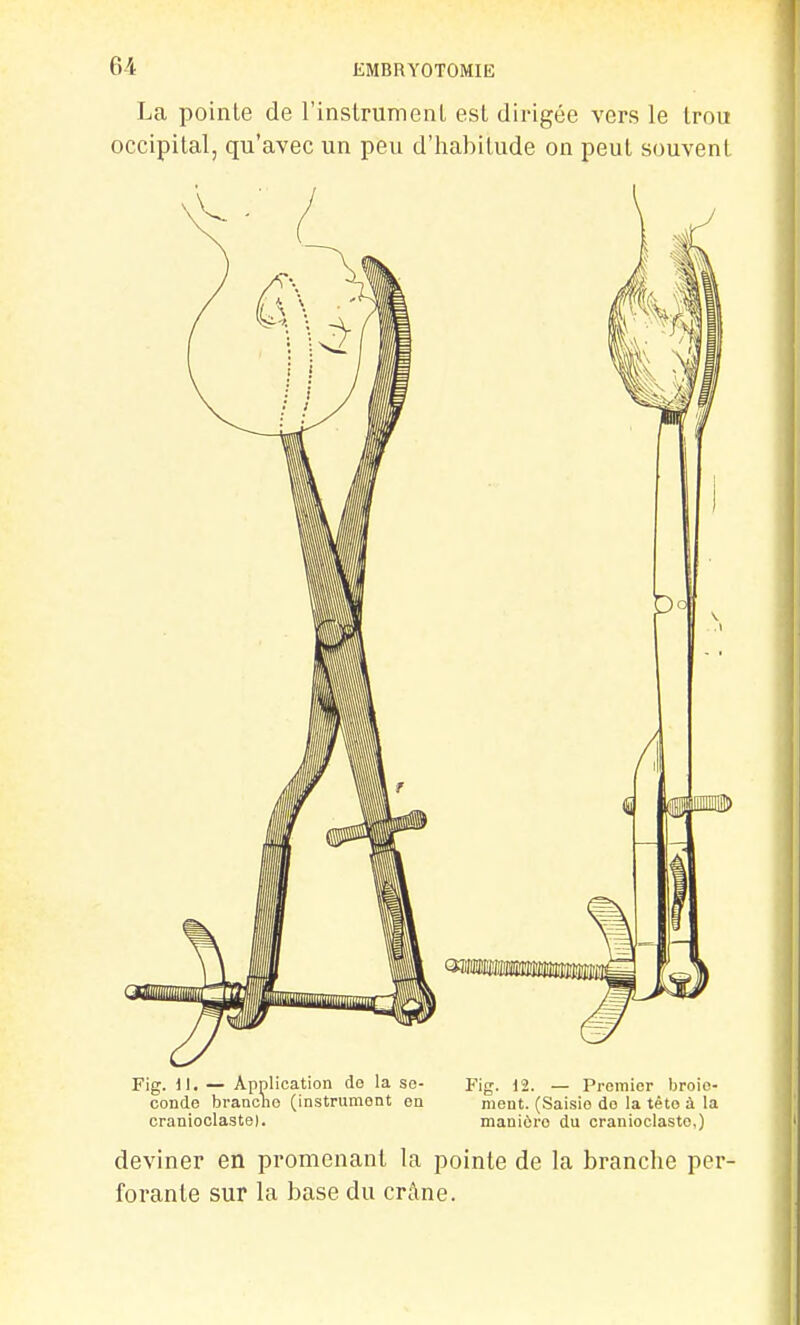 La pointe de l'instrumenl est dirigée vers le Irou occipital, qu'avec un peu d'habitude on peut souvent Fig. 11. — Application de la se- Fig. 12. — Premier broio- conde branche (instrument en ment. (Saisie de la têto à la cranioclaste). manière du cranioclasto,) deviner en promenant la pointe de la branche per- forante sur la base du crâne.