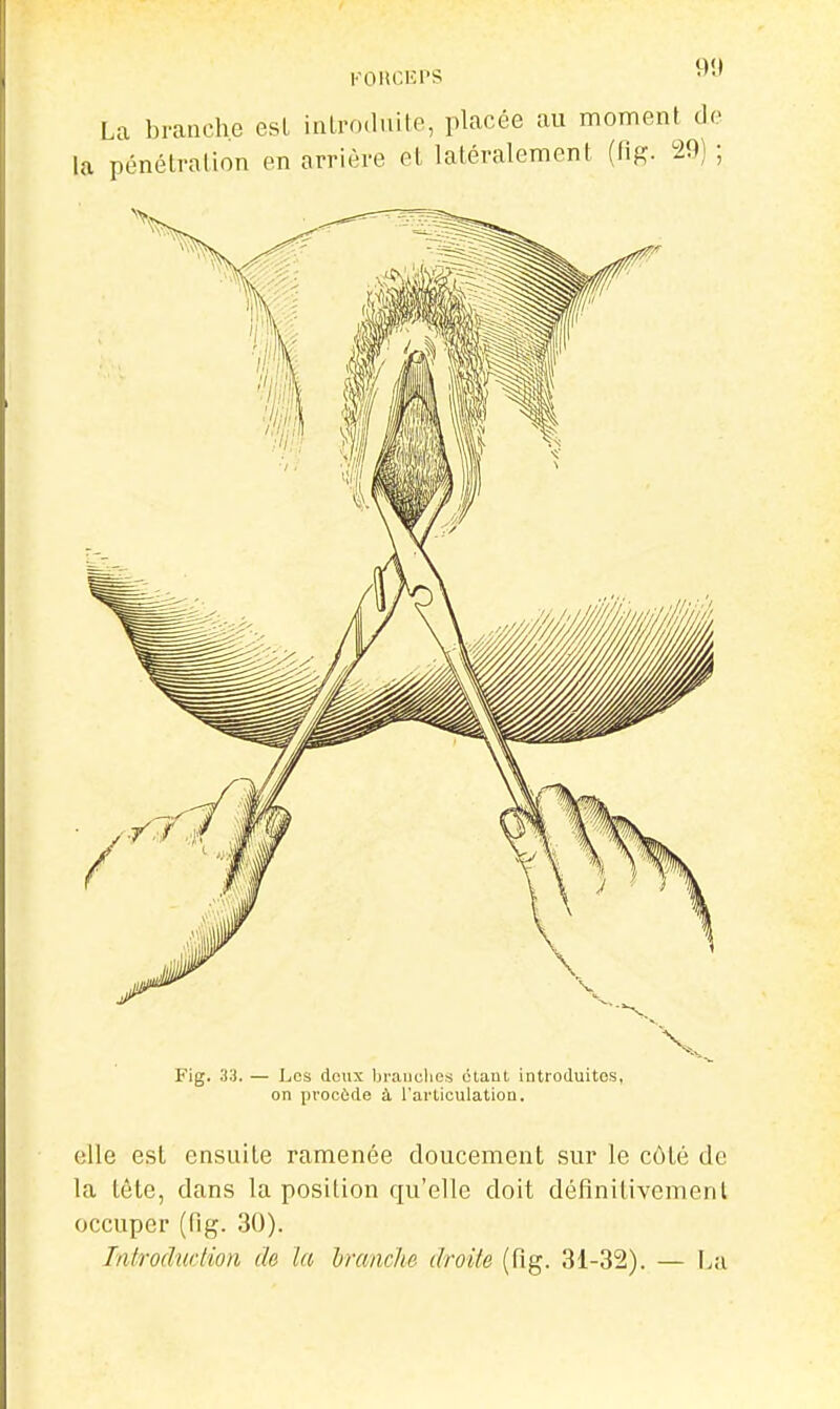 KOKCIîPS La branche esL inlro.luite, placée au moment de la pénétration en arrière et latéralement {dg. 29) ; Fig. 33. — Les doux bi'auclies étant introduites, on procède à l'articulation. elle est ensuite ramenée doucement sur le côté de la tête, dans la position qu'elle doit déflnitivemenl occuper (fig. 30). Introduction de ta IjrancJie droite (fig. 31-32). — I>a