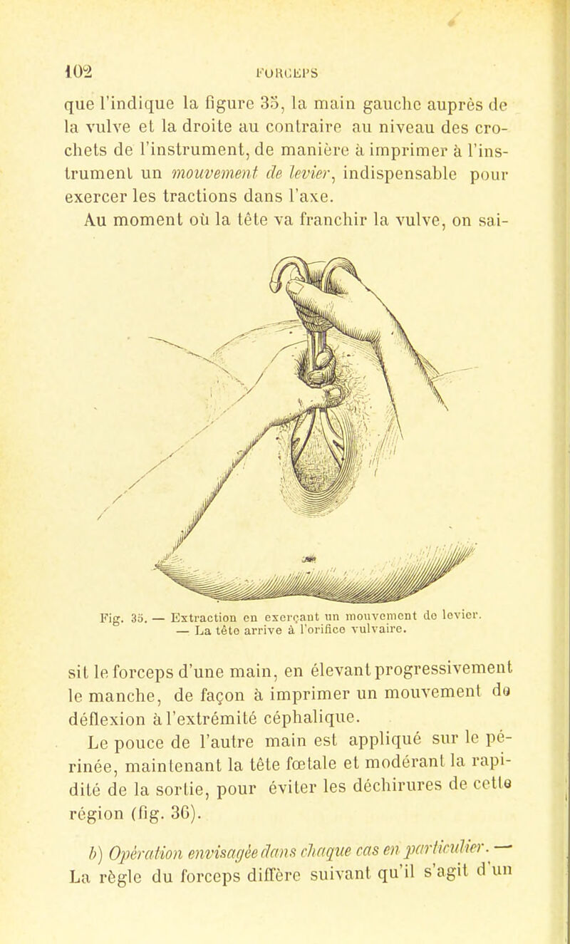 que l'indique la figure 3o, la main gauche auprès de la vulve et la droite au contraire au niveau des cro- chets de l'instrument, de manière à imprimer à l'ins- trument un mouvement de levier^ indispensable pour exercer les tractions dans l'axe. Au moment où la tête va franchir la vulve, on sai- sit le forceps d'une main, en élevant progressivement le manche, de façon à imprimer un mouvement de déflexion à l'extrémité céphalique. Le pouce de l'autre main est appliqué sur le pé- rinée, maintenant la tête fœtale et modérant la rapi- dité de la sortie, pour éviter les déchirures de cette région (fig. 36). h) Opération envisagée dans cMque cas en partimlier . — La règle du forceps difl'ère suivant qu'il s'agit d'un