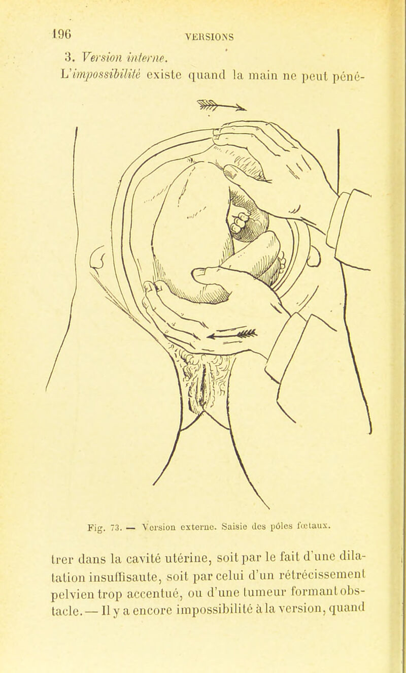 3. Version interne. Vimpossibilité existe quand la main ne peut péné- Fig. 3. — Version externe. Saisie des pôles l'œlaux. trer dans la cavité utérine, soit par le fait d'une dila- tation insuffisante, soit par celui d'un rétrécissemenl pelvien trop accentué, ou d'une lumeur formant obs- tacle. — 11 y a encore impossibilité à la version, quand