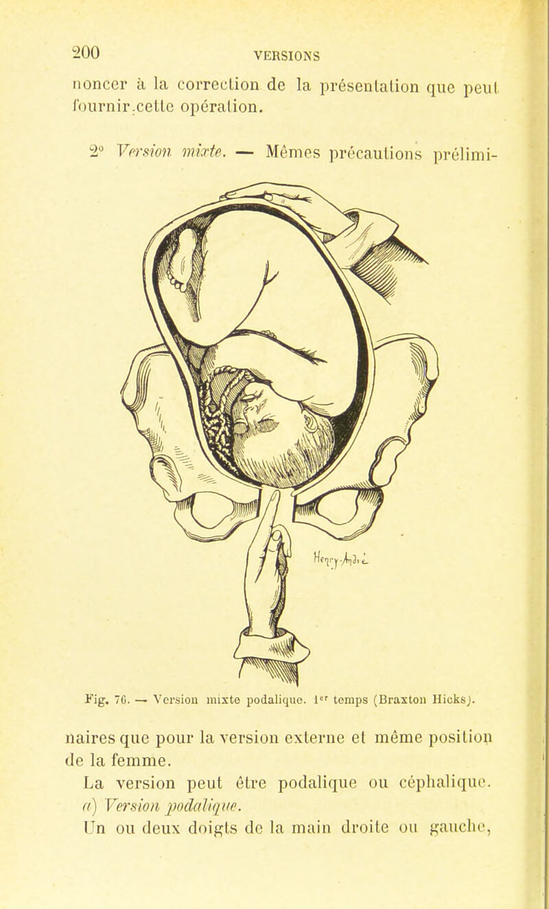 noncer à la coiTeclion de la présealalion que peiil l'ournir.cette opération. 2° Vprsion mixte. — Mêmes précautions prélimi- Fig. 7C. — Version mixte podalique. 1 temps (Braxton HicksJ. naires que pour la version externe et même position de la femme. La version peut être podalique ou céphaliquo. a) Version podalique. Un ou deux doigts de la main droite ou gauclic,