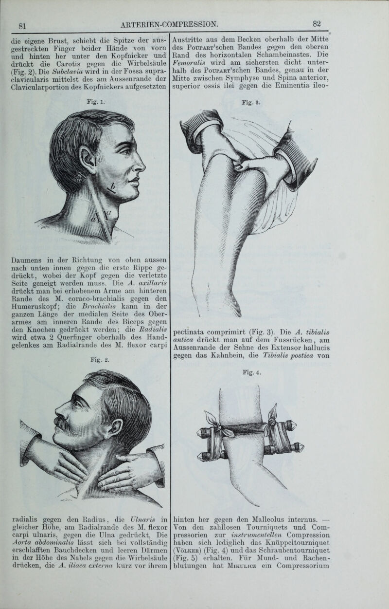 die eigene Brust, schiebt die Spitze der aüs- gestreckten Finger beider Hände von vorn und hinten her unter den Kopfnicker und drückt die Carotis gegen die Wirbelsäule (Fig. 2). Die Subclavia wird in der Fossa supra- clavicularis mittelst des am Aussenrande der Clavicularportion des Kopfnickers aufgesetzten Fig. l. Daumens in der Richtung von oben aussen nach unten innen gegen die erste Rippe ge- drückt, wobei der Kopf gegen die verletzte Seite geneigt werden muss. Die A. axillaris drückt man bei erhobenem Arme am hinteren Rande des M. coraco-brachialis gegen den Humeruskopf; die Brachialis kann in der ganzen Länge der medialen Seite des Ober- armes am inneren Rande des Biceps gegen den Knochen gedrückt werden; die Radialis wird etwa 2 Querfinger oberhalb des Hand- gelenkes am Radialrande des M. flexor carpi Fig. 2. radialis gegen den Radius, die XJlnaris in gleicher Höhe, am Radialrande des M. flexor carpi ulnaris, gegen die Ulna gedrückt. Die Aorta abdominalis lässt sich bei vollständig erschlafften Bauchdecken und leeren Därmen in der Höhe des Nabels gegen die Wirbelsäule drücken, die A. iliaca externa kurz vor ihrem Austritte aus dem Becken oberhalb der Mitte des Poüpart’sehen Bandes gegen den oberen Rand des horizontalen Schambeinastes. Die Femoralis wird am sichersten dicht unter- halb des PouPART’schen Bandes, genau in der Mitte zwischen Symphyse und Spina anterior, superior ossis ilei gegen die Eminentia ileo- Fig. 3. pectinata comprimirt (Fig. 3). Die A. tibialis antica drückt man auf dem Fussrücken, am Aussenrande der Sehne des Extensor hallucis gegen das Kahnbein, die Tibialis postica von Fig. 4. hinten her gegen den Malleolus internus. — Von den zahllosen Tourniquets und Com- pressorien zur instrumenteilen Compression haben sich lediglich das Knüppeltourniquet (Völker) (Fig. 4) und das Schiaubentourniquet (Fig. 5) erhalten. Für Mund- und Rachen- blutungen hat Mikulicz ein Compressorium