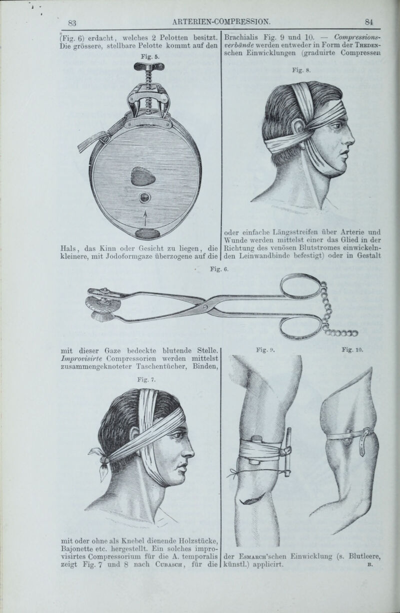 (Fig. 6) erdacht, welches 2 Pelotten besitzt. Die grössere, stellbare Pelotte kommt auf den Fig. 5. Hals, das Kinn oder Gesicht zu liegen, die kleinere, mit Jodoformgaze überzogene auf die Brachialis Fig. 9 und 10. — Cotnpressions- verbände werden entweder in Form der Thedex- schen Einwicklungen (graduirte Compressen Fig. 8. oder einfache Längsstreifen über Arterie und Wunde werden mittelst einer das Glied in der Richtung des venösen Blutstromes einwickeln- den Leinwandbinde befestigt) oder in Gestalt Fig. mit dieser Gaze bedeckte blutende Stelle. Improvisirte Compressorien werden mittelst zusammengeknoteter Taschentücher, Binden, Fig. 7. mit oder ohne als Knebel dienende Holzstücke, Bajonette etc. hergestellt. Ein solches impro- visirtes Compressorium für die A. temporalis zeigt Fig. 7 und 8 nach Cubasch, für die Fisr. a Fig. 10. der EsMARCH’schen Einwicklung (s. Blutleere, künstl.) applicirt. b.