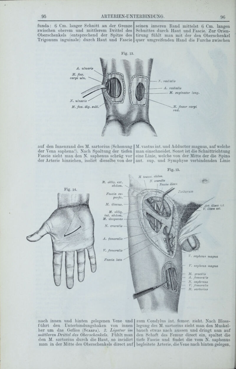 funda: 6 Cm. langer Schnitt an der Grenze zwischen oberem und mittlerem Drittel des Oberschenkels (entsprechend der Spitze des Trigonum inguinale) durch Haut und Fascie seinen inneren Rand mittelst 6 Cm. langen Schnittes durch Haut und Fascie. Zur Orien- tirung fühlt man mit der den Oberschenkel quer umgreifenden Hand die Furche zwischen Fig. 13. N. ulnaris 31. flex. dig. subl. carpi A. ulnaris 31. flex. carpi uln. .V. radialis A. radialis 3f. supinatar long. auf den Innenrand des M. sartorius (Schonung der Yena saphena!). Nach Spaltung der tiefen Fascie sieht man den N. saphenus schräg vor der Arterie hinziehen, isolirt dieselbe von der M. vastus int. und Adductor magnus, auf welche man einschneidet. Sonst ist die Schnittrichtung eine Linie, welche von der Mitte der die Spina ant. sup. und Symphyse verbindenden Linie Fig. 15. Fig. 14. 31. obliq. ext. abdom. Feuern sv- perfle. 31. iliacus. M. obliq. int. abdom. 31. ileopsoas N. crura’is A. femoralis V. femoralis Fascia lata 31 transc. abdom. F. cmralis Fascia iliacu Firitoneta» 1’. saphena magna V. saphena magna 31. graeitis A. femora'is X. saphrnvs V. femoralis 3f. sartorius Art. iliaca r.t r. iltaea ext. nach innen und hinten gelegenen Vene und führt den Unterbindungshaken von innen her um das Gefäss (Scarpa). 2. Ligatur im mittleren Drittel des Oberschenkels. Fühlt man den M. sartorius durch die Haut, so incidirt man in der Mitte des Oberschenkels direct auf zum Condylus int. femor. zieht. Nach Bloss- legung des M. sartorius zieht man den Muskel- bauch etwas nach aussen und dringt nun auf den Schaft des Femur direct ein, spaltet die tiefe Fascie und findet die vom N. saphenus begleitete Arterie, die Vene nach hinten gelegen.