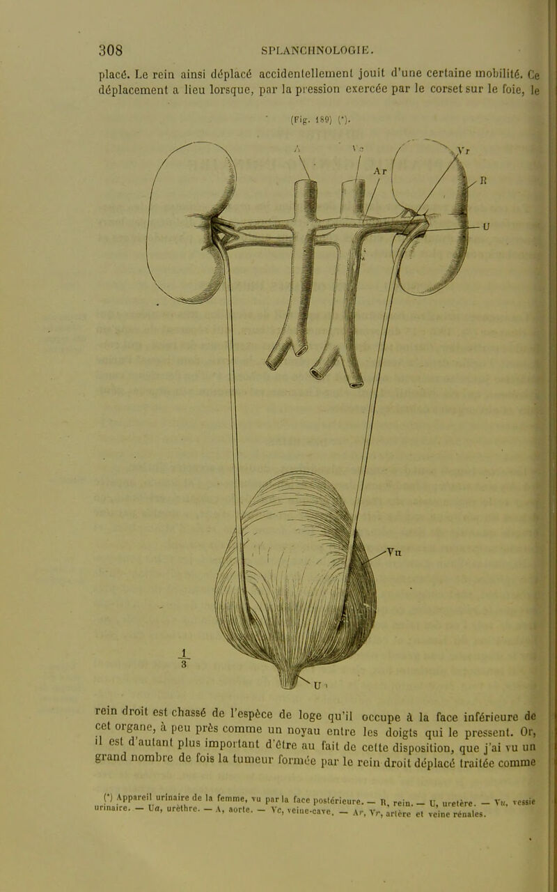 placé. Le rein ainsi déplacé accidenlellemenl jouit d'une certaine mobilité. Ci déplacement a lieu lorsque, par la pression exercée par le corset sur le foie, h (Fig. 189) ('). rem droit est chassé de l'espèce de loge qu'il occupe à la face inférieure do cet organe, à peu près comme un noyau entre les doigts qui le pressent. Or, Il est d'autant plus important d étre au fait de cette disposition, que j'ai vu un grand nombre de fois la tumeur formée par le rein droit déplacé traitée comme P Appareil urinairc de la femme, vu par la face postérieure. - n. rein. - U uretère - T„, vessie urinaire. — La, urethre. — A, aorte. — Vc, vciiic-cnvp _ a,, v.. . • • i , ouiic. iLiuL-cave. — .Ar, ^r, arlerc et veine rénales.