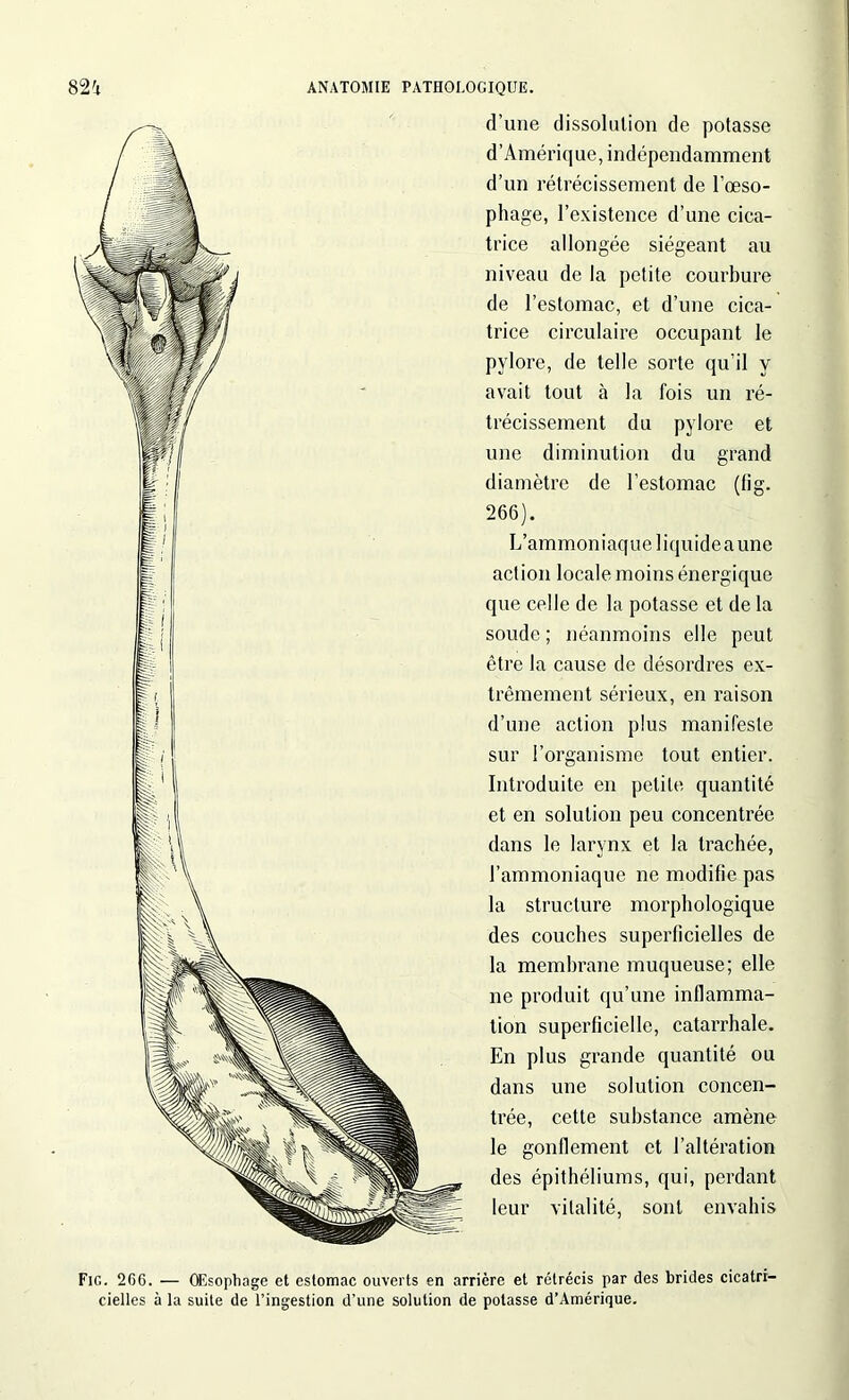 d’une dissolution de potasse d’Amérique, indépendamment d’un rétrécissement de l’œso- phage, l’existence d’une cica- trice allongée siégeant au niveau de la petite courbure de l’estomac, et d’une cica- trice circulaire occupant le pylore, de telle sorte qu’il y avait tout à la fois un ré- trécissement du pylore et une diminution du grand diamètre de l’estomac (fig. 266). L’ammoniaque liquide aune action locale moins énergique que celle de la potasse et de la soude ; néanmoins elle peut être la cause de désordres ex- trêmement sérieux, en raison d’une action plus manifeste sur l’organisme tout entier. Introduite en petite quantité et en solution peu concentrée dans le larynx et la trachée, l’ammoniaque ne modifie pas la structure morphologique des couches superficielles de la membrane muqueuse; elle ne produit qu’une inflamma- tion superficielle, catarrhale. En plus grande quantité ou dans une solution concen- trée, cette substance amène le gonflement et l’altération des épithéliums, qui, perdant leur vitalité, sont envahis Fig. 2G6. — OEsophage et estomac ouverts en arrière et rétrécis par des brides cicatri- cielles à la suite de l’ingestion d’une solution de potasse d’Amérique.