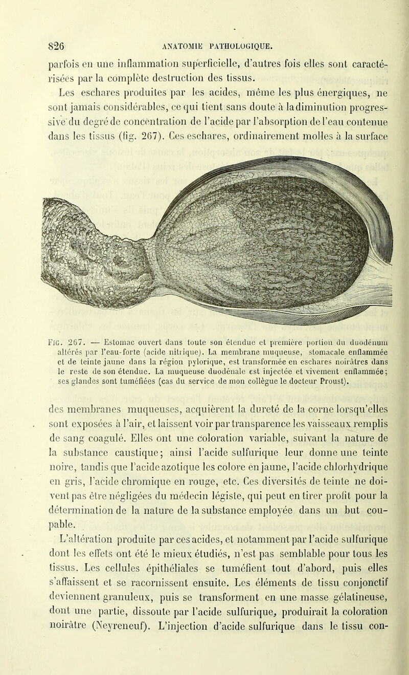 parfois en une inflammation superficielle, d’autres fois elles sont caracté- risées par la complète destruction des tissus. Les eschares produites par les acides, même les plus énergiques, ne sont jamais considérables, ce qui tient sans doute à la diminution progres- sive du degré de concentration de l’acide par l’absorption de l’eau contenue dans les tissus (fig. 267). Ces eschares, ordinairement molles à la surface Fig. 267. — Estomac ouvert dans toute son étendue et première portion du duodénum altérés par l’eau-forte (acide nitrique). La membrane muqueuse, stomacale enflammée et de teinte jaune dans la région pylorique, est transformée en eschares noirâtres dans le reste de son étendue. La muqueuse duodénale est injectée et vivement enflammée; ses glandes sont tuméfiées (cas du service de mon collègue le docteur Proust). des membranes muqueuses, acquièrent la dureté de la corne lorsqu’elles sont exposées à l’air, et laissent voir par transparence les vaisseaux remplis de sang coagulé. Elles ont une coloration variable, suivant la nature de la substance caustique ; ainsi l’acide sulfurique leur donne une teinte noire, tandis que l’acide azotique les colore en jaune, l’acide chlorhydrique en gris, l’acide chromique en rouge, etc. Ces diversités de teinle ne doi- vent pas être négligées du médecin légiste, qui peut en tirer profit pour la détermination de la nature de la substance employée dans un but cou- pable. L’altération produite par ces acides, et notamment par l’acide sulfurique dont les effets ont été le mieux étudiés, n’est pas semblable pour tous les tissus. Les cellules épithéliales se tuméfient tout d’abord, puis elles s’affaissent et se racornissent ensuite. Les éléments de tissu conjonctif deviennent granuleux, puis se transforment en une masse gélatineuse, dont une partie, dissoute par l’acide sulfurique, produirait la coloration noirâtre (Neyreneuf). L’injection d’acide sulfurique dans le tissu con-