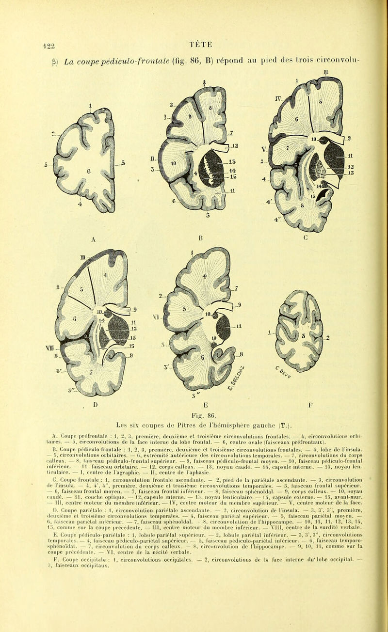 La coupe pédiculo-frontale (fig. 86, B) répond au pied des Irois circoiivolu- D E F Fig. 86. Les six coupes de Pitres de riiéniisphère gauciie (T.). A. Coupe préfronlale : 1, i, 3, première, deuxième el troisième circonvolulions frontales. — 4, circonvolutions orbi- Uires. — b, circonvolutions de la l'ace interne du lobe frontal. — 6, centre ovale (faisceaux préfrontanx). B. Coupe pédiculo-Irontale : 1, 2, 3, première, deuxième el troisième circonvolutions frontales. — 4, lobe de l'insula. — H, circonvolulions orbitaires. — 0, extrémité ariténcure des cireonvolutinns temporales. — 7, circonvolutions du corps calleux. —8, laisf^eau pédiculo-frontal supérieur. —9, faisceau pédiculo-frontal moyen.— iU, faisceau pédicuki-frontal inférieur. — il faisceau orbitairo. — 12, corps calleux. — 13, noyau caudé. — 14, capsule interne. — 15, noyau len- ticulaire. — 1, contre de l'agrapliic. — II, centre de Faiihasie. C. Coupe frontale : 1, circonvolution frontale ascendante. — 2, pied de la pariétale ascendante. — 3, circonvolution de l'insula. — 4. 4', 4, première, deuxième et troisième circonvolutions temporales. — 5, faisceau frontal supérieur. — 6, faisceau frontal moyeu. — 7, faisceau frontal inférieur. — 8, faisceau spliénoïdal. — 9, corps chIIcux. — 10, noyau e<iudè. — 11. couche optique. — 12, capsule interne. — 13. noyau lenticulaire. — 14, capsule cxierne. — 15, avaut-niur. — 111, centre moteur du membre inférieur. — IV, centre moteur du membre supérieur. — V, centre moteur delà face. D. Coupe pariétale ; 1, circonvolution pariétale asceudaiile. — 2, circonvolution de l'insula. — 3, 3'. 3, première, deuxième et troisième circonvolutions temporales. — 4, faisceau pai'iéla! supérieur. — 5, faisceau pariétal mo_\en. — (1, faisceau pariétal inférieur. — 7, faisceau sphéuoïdal. - 8, circonvolution di' l'hippocampe. — 10, 11, 11, 12, 13, 14, lo, comme sur la coupe précédente. — 111, centre moteur du membre inférieur. — VIII, centre de la surdité verbale. E. Coupe pédiculo-pariétale : 1, lobule pariétal supérieur. — 2, lobule pariétal inférieur. — 3, 3', 3, circonvolulions temporales. — 4, faisceau pédiculo-pariétal supérieur. — 5, faisceau pédiculo-pariétal intérieur. — O, faisceau lemporo- sphéno'idal. — 7, circonvolution du coips calleux. — 8, circnuvolution de I hippocampe. — 9, 10, II, comme sur la coupe précédente. — VI, cenlre de la cécité \erbalr. F. Coupe occipitale : I, circonvolutions occipitales. — 2, circonvolulions de la face interne du'lobe occipital. - faisceaux occipitaux.