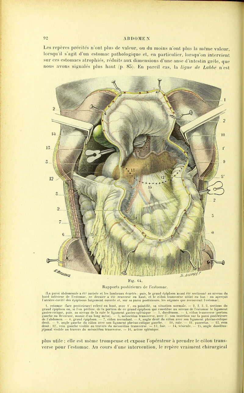 Les repères précités n'ont plus de valeur, ou du moins n'ont plus la même valeur, lorsqu'il s'agit d'un estomac pathologique et, en particulier, lorsqu'on intervient sur ces estomacs atrophiés, réduits aux dimensions d'une anse d'intestin grêle, que nous avons signalés plus haut (p. 80). En pareil cas, la ligne de Labbé n'est Rapports postérieurs de l'estomac. (La paroi abdominale a été incisée el les lambeaux écartés : puis, le grand épiploon ayant été sectionné au niveau du bord inférieur de l'estomac, ce dernier a été renversé en haut, et le cùlon transverse attiré en bas : on aperçoit l'arrière-cavité des épiploons largement ouverte et, sur sa paroi postérieure, les organes que recouvrait l'estomac). 1. estomac (face postérieure) relevé en haut, avec \\ en pointillé, sa situation normale. — 2, 2, 2, 2, sections du grand épiploon ou, si l'on préfère, de la portion de ce grand épiploon qui constitue au niveau de l'esloniac le ligament gastro-colique, puis, au niveau de la rate le ligament gastro-splénique — duodénum. — 4, côlon transverse (portion gauche ou Ilexueuse, munie d un long méso). - 5, mésocôlon transvcrse, avec 5'. son insertion sur la paroi poslérieure de l'abdomen. — 0. grand épiploon. — 7, côlon ascendant. — 8, anglo droit du côlon avec son ligament pliréno-colique droit. — 9, angle gauche du côlon avec son ligament phréno-colique gauche. - tO, rate. — It. pancréas. — 12, rein droit; 12', l'ein gauche visible au travers du mésocôlon Iransverse. — 13, foie, — 14, vésicule. — 1,5, angle duodéno- jéjunal visible au travers du mésocôlon transverse. — 16, artère splénique. plus utile ; elle est même trompeuse et expose l'opérateur à prendre le côlon trans- verse pour l'estomac. Au cours d'une intervention, le repère vraiment chirurgical