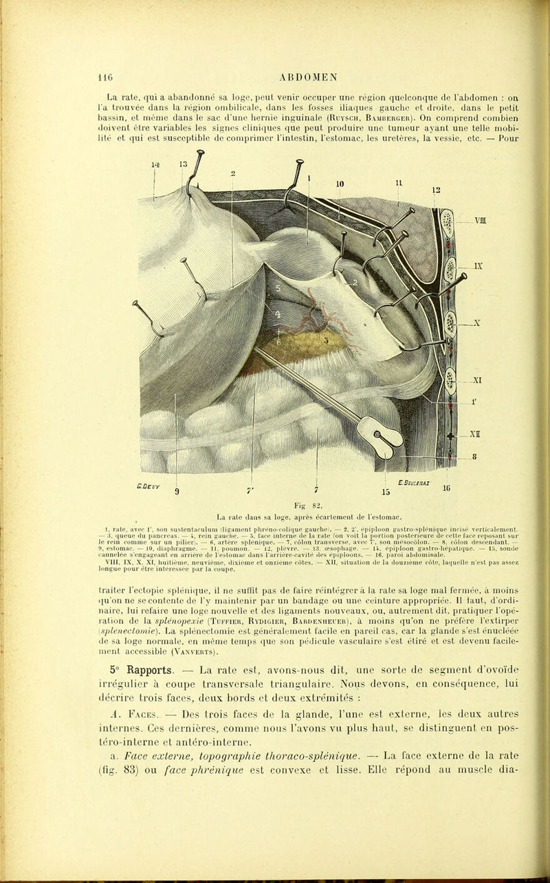 La rate, qui a abandonné sa loge, peut venir occuper une région quelconque de l'abdomen : on l'a trouvée dans la région ombilicale, dans les fosses iliaques gauche et droite, dans le petit bassin, et même dans le sac d'une hernie inguinale (Ruysch, Bamberger). On comprend combien doivent être variables les signes cliniques que peut produire une tumeur ayant une telle mobi- lité et qui est susceptible de comprimer l'intestin, l'estomac, les uretères, la vessie, etc. — Pour Fig 82. La rate dans sa loge, après écartement de l'estomac. i. rate, avec 1', son sustentaculum (ligament phrèno-coli({ue gauche). — 2, 2'. épiploon gastro-spiéniquo ineis(> verticalement. — 3, queue du pancréas. — 4, rein gauclie. — a, face interne (le la rate [on voit la portion postérieure de celte face reposant sur le rein comme sur un pilier). — 6, artère splénique. — 7, côlon transverse, avec T, son mésocôlon. — 8, côlon descendant. — 9, estomac. — jO, diaphragme. — 11, poumon. — 12, plèvre. — 13. œsophage. — 14, épiploon gastro-hépatique. — to, sonde cannelée s'engageant en arrière de l'estomac dans l'arrière-cavité des épiploons. — 16, paroi abdominale. VIII, IX, X. XI, huitième, neuvième, di.\iême et onzième côtes. — XII, situation de la douzième côte, laquelle n'est pas assez longue pour être intéressée par la coupe, traiter l'ectopie splénique, il ne suffit pas de faire réintégrer à la rate sa loge mal fermée, à moins (ju'on ne se contente de l'y maintenir par un bandage ou une ceinture appropriée. 11 faut, d'ordi- naire, lui refaire une loge nouvelle et des ligaments nouveaux, ou, autrement dit, pratiquer l'opé- ration de la splénopexie (ïukfier, Rydigier, B-\ri)enheier), à moins qu'on ne préfère l'extirper (splenectomie). La splénectomie est généralement facile en pareil cas, car la glande s'est énucléée de sa loge normale, en môme temps que son pédicule vasculaire s'est étiré et est devenu facile- ment accessible (Vaxverts). 5° Rapports. — La rate est, avons-nous dit, une sorte de segment d'ovo'ide irrégulier à coupe transversale triangulaire. Nous devons, en conséquence, lui décrire trois faces, deux bords et deux extrémités : Â. Faces. — Des trois faces de la glande, l'une est externe, les deux autres internes. Ces dernières, comme nous l'avons vu plus haut, se distinguent en pos- téro-interne et antéro-interne. a. Face externe, topographie thoraco-splénique. — La face externe de la rate (fig. 83) ou face phrénique est convexe et lisse. Elle répond au muscle dia-