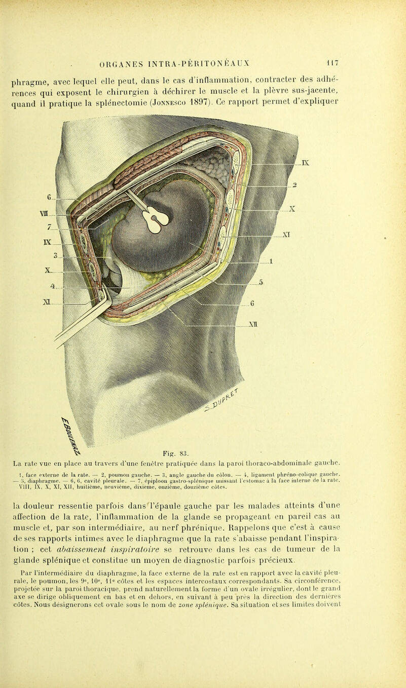 phragme, avec lequel elle peut, dans le cas d'inflammation, contracter des adhé- rences qui exposent le chirurgien à déchirer le muscle et la plèvre sus-jacente, quand il pratique la splénectomie (Jonnesgo 1897). Ce rapport permet d'expliquer V Fig. 83. La rate vue en place au travers d'une fenêtre pratiquée dans la paroi thoraco-abdominale gauche. 1, face externe de la rate. — 2, poumon gauche. — 3, angle gauche du colon. — 4, ligament phréno-colique gauche. — 5, diaphragme. — 6, 0, cavité pleurale. — 7, épiploon gastro-splénirpie unissant l'estomac à la l'ace interne de la rate. VIII, l.Y, X, XI, XII, huitième, neuvième, dixième, onzième, douzième côtes. la douleur l'essentie parfois dans l'épaule gauche par les malades atteints d'une affection de la rate, l'inflammation de la glande se propageant en pareil cas au muscle et, par son intermédiaire, au nerf phréniquc. Rappelons que c'est à cause de ses rapports intimes avec le diaphragme que la rate s'abaisse pendant l'inspira- tion ; cet abaissement inspiratoire se retrouve dans les cas de tumeur de la glande splénique et constitue un moyen de diagnostic parfois précieux. Par l'intermédiaire du diaphragme, la face externe de la rate est en rapport avec la cavité pleu- rale, le poumon, les 9% 10°, 11° côtes et les espaces intercostaux correspondants. Sa circonférence, projetée sur la paroi thoracique, prend naturellement la l'orme d'un ovale irrégulier, dont le grand axe se dirige obliquement en bas et en dehors, en suivant à peu près la direction des dernières côtes. Nous désignerons cet ovale sous le nom de zone splénique. Sa situation et ses limites doivent