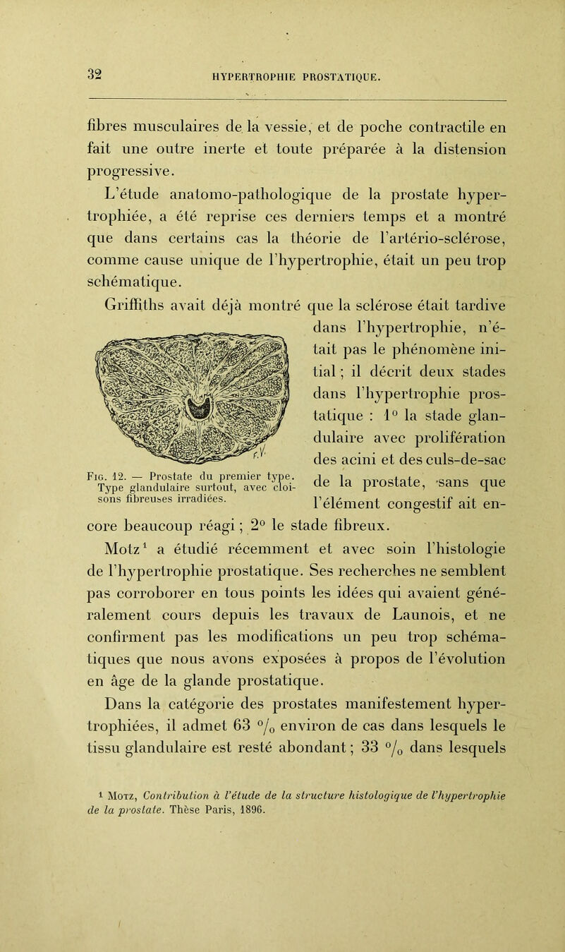 fibres musculaires de. la vessie, et de poche contractile en fait une outre inerte et toute préparée à la distension progressive. L’étude anatomo-pathologicpie de la prostate hyper- trophiée, a été reprise ces derniers temps et a montré que dans certains cas la théorie de l’artério-sclérose, comme cause unique de l’hypertrophie, était un peu trop schématique. Griffiths avait déjà montré que la sclérose était tardive dans l’hypertrophie, n’é- tait pas le phénomène ini- tial ; il décrit deux stades dans l’hypertrophie pros- tatique : 1° la stade glan- dulaire avec prolifération des acini et des culs-de-sac de la prostate, 'sans que l’élément congestif ait en- core beaucoup réagi ; 2° le stade fibreux. Motz1 a étudié récemment et avec soin l’histologie de l’hypertrophie prostatique. Ses recherches ne semblent pas corroborer en tous points les idées qui avaient géné- ralement cours depuis les travaux de Launois, et ne confirment pas les modifications un peu trop schéma- tiques que nous avons exposées à propos de l’évolution en âge de la glande prostatique. Dans la catégorie des prostates manifestement hyper- trophiées, il admet 63 °j0 environ de cas dans lesquels le tissu glandulaire est resté abondant ; 33 °/0 dans lesquels Fig. 12. — Prostate du premier type. Type glandulaire surtout, avec cloi- sons fibreuses irradiées. 1 Motz, Contribution à l’étude de la structure histologique de l’hypertrophie de la prostate. Thèse Paris, 1896.