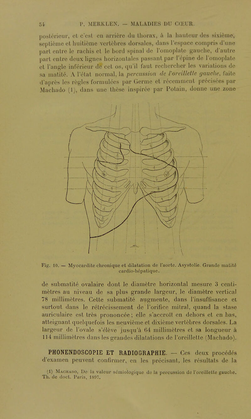 posterieur, cL c'cst cn arriere du lliorax, a la hauteur des sixieme, septieme el huitieme vertebres dorsales, dans l'espace compris d'une pari entre le rachis ct le bord spinal dc TomoplaLc gauche, d'aulre pari enlre deux lignes horizonlales passant par Tepine de lomoplalc el Tangle inferieur dc eel os, qu'il faul rcchcrcher les variations dc sa matite. A 1 etat normal, la percussion de Voreillette gauche, faite d'apres les regies formulees par Germe et recemmcnt precisees par Machado (1), dans unc these inspiree par Potain, donne une zone Fig. 10. — Myocardile chronique et dilatation de l'aorte. Asystolie. Grande matite cardio-hepatique. de submatite ovalaire dont le diametre horizontal mesure 3 centi- metres au niveau de sa plus grande largcur, le diametre vertical 78 millimetres. Cette submatite augmente, dans l'insuffisance et surtout dans le retr6cissement dc l'orifice mitral, quand la slase auriculaire est tres prononcee; elle s'accroit cn dehors et cn bas, atteignant quelquefois les neuvicme et dixieme vertebres dorsales. La largeur de l'ovale s'elcve jusqu'i 64 millimetres ct sa longueur a 114 millimetres dans les graudes dilatations dc roreillclle (Machado). PHONENDOSCOPIE ET RADIO GRAPHIE. — Ges deux proccdes d'examen peuvent confirmer, en les precisant, les resultats dc la (1) Machado, Dc la valcur scmiologiquc de In percussion de 1'orcilletle gauclie. Th. dc doct. Paris, 1897.