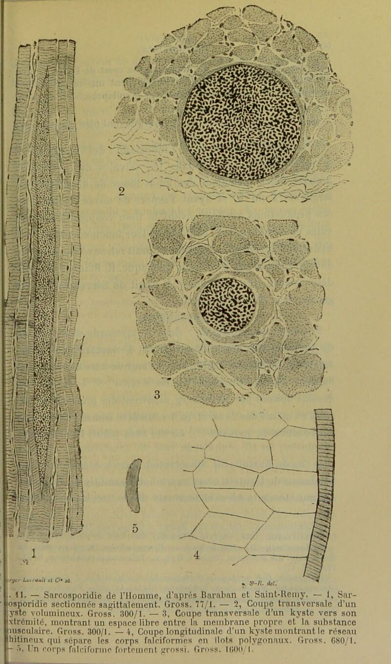 j. 11. — Sarcosporidie de l’Homme, d'après Ilaraban et Saint-Rémy, — 1, Sar- losporidie sectionnée sagittalement. Gross. 77/1. — 2, Coupe transversale d’un ;yste volumineux. Gross. 300/1. — 3, Coupe transversale d’un kyste vers son ixtrémité, montrant un espace libre entre la membrane propre et la. substance msculaire. Gross. 300/1. —i, Coupe longitudinale d’un kyste montrant le réseau hitineux qui sépare les corps falciformes en îlots polygonaux. Gross. 680/1. - 5, fn corps falciforme fortement grossi. Gross. 1000/1.