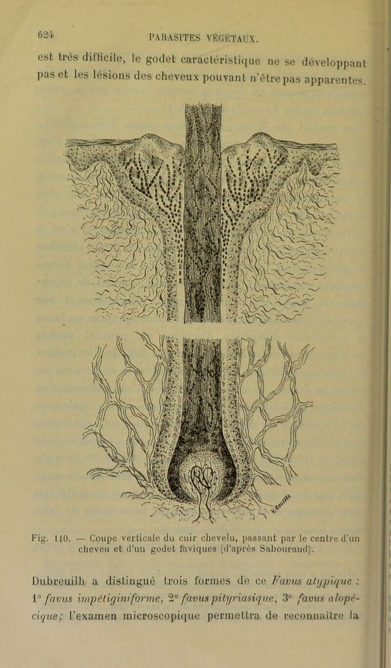 est très difficile, le godet caractéristique ne se développant pas et les lésions des cheveux pouvant n’êtrepas apparentes. Fig. 110. — Coupe verticale du cuir chevelu, passant par le centre d’un cheveu et d’un godet faviques (d’après Sabouraud). *■ Duhreuilh a distingué trois formes de ce Favus ali/pique : 1° favus irnpéliginiforme, 2° favus pilyriasique, 3° favus alopé- cir/ue; l’examen microscopique permettra de reconnaître la