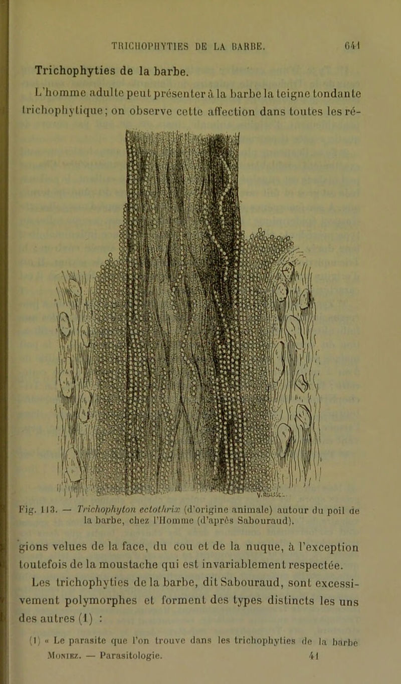 Trichophyties de la barbe. L’homme adulte peul présenter à la barbe la teigne tondante trichophylique; on observe cette affection dans toutes les ré- Fig. 113. — Tricliophyton ectothrix (d’origine animale) autour du poil do la barbe, chez l’Homme (d’après Sabouraud). gions velues de la face, du cou et de la nuque, à l’exception toutefois de la moustache qui est invariablement respectée. Les trichophyties de la barbe, dit Sabouraud, sont excessi- vement polymorphes et forment des types distincts les uns des autres (1) : (1) « Le parasite que l’on trouve dans les trichophylies de la barbe