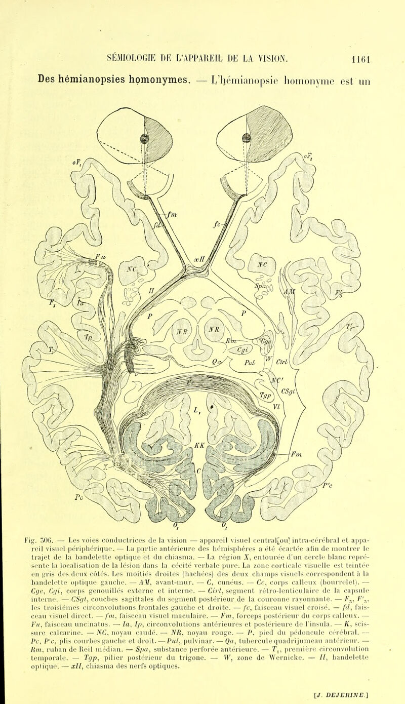 Des hémianopsies homonymes, — T/lirmianopsio Iinmonvirio est un Fif;. 7)1)13. — Los voies conductrices de la vision — appareil visuel eenlral[oa^ intra-cérrbral et appa- l'cil visuel péri|ihériiiue. — La partie antérieure des hémisplières a été écartée alin de montrer le trajet de la liandelette optique et du cliiasma. —La ré{;ion X, entourée d'un cercle blanc repré- si'ule la localisation de la lésion dans la cécité verbale pure. La zone corticale visuelle est teintée en t;ris dos deux côtés. Les moitiés droites (hachées) dos deu.ic champs visuels correspondent à la bandelette optique gauche. —A.tf, avant-mur. — C, cunéus. — Ce. corps calleux (bourrelet). — (Ulc l'.iji, corps genouillés externe et interne. — Ciii, segment rétro-lenticulaire de la capsule ml. 1111'. — CiV//, couches sagittales du segment postérieur de la couronne rayonnante. — Fj, /■''-. li's iruisiéuies circonvolutions frontales gauche et droite. — fc, faisceau visuel croisé. — fd, fais- ceau visuel direct. — fin, faisceau visuel maculaire. — f?n, forceps postérieur du corps calleux. — l'ii, faisceau uncinatus. —■ la, Ij>, circonvolutions antérieures et postérieure de l'insula. — K, scis- sure calcarine. — NC, noyau caudé. — iVfi, noyau rouge. —• P, pied du pédoncule céi-ébral. — l'c, P'c, plis courbes gauche et droit. — Pul, pulvinar. — Qa, tubercule quadrijumeau antérieur. — Itin. ruban de Iteil nii'dian. — S/ia, substance perforée antérieure. — T,, première circonvolution temporale. — Ti/p. piller iiostérieur du trigone. — W, zone de Wernicke. — //, bandelette oplique. — xll, cliiasma des nerfs optiques.