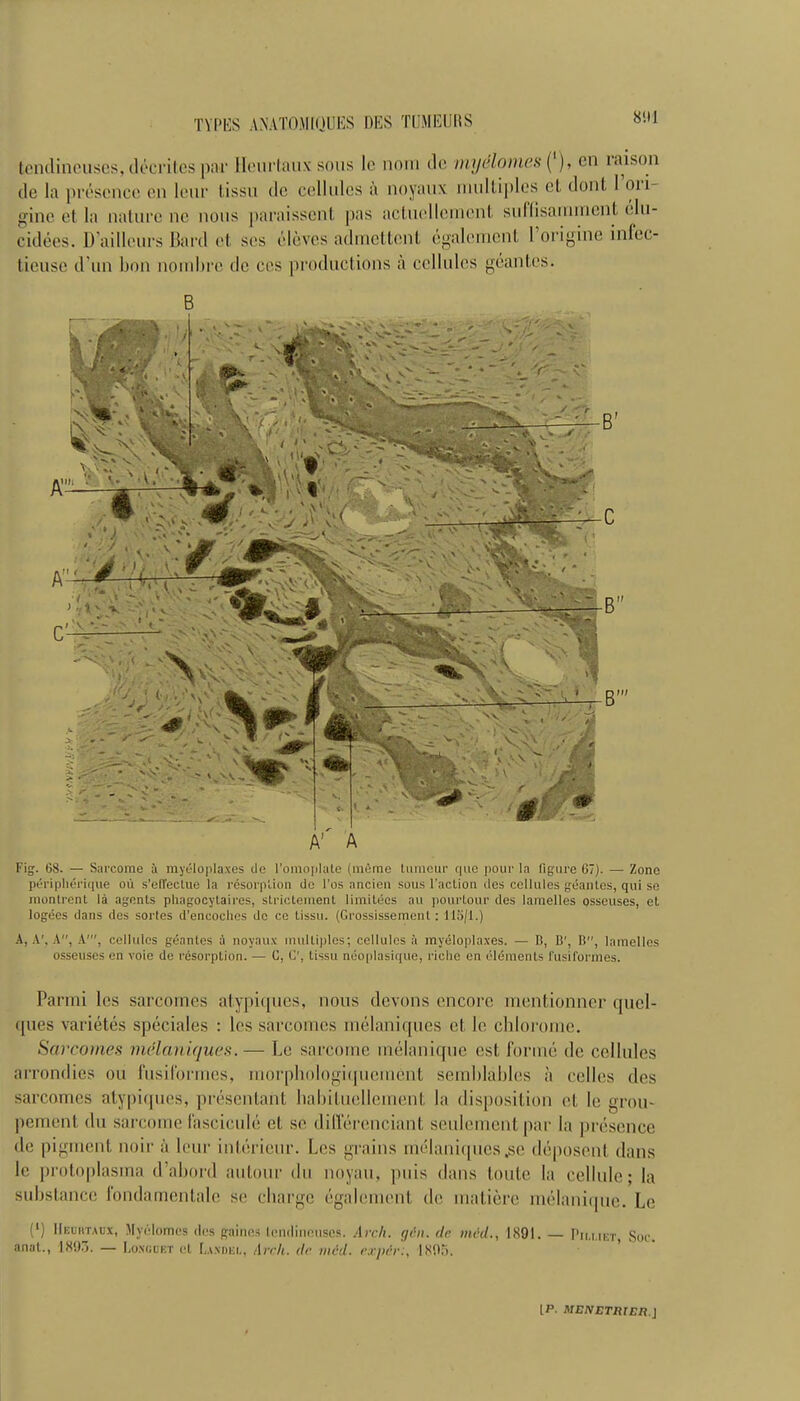 8!U tendincuses, dec riles par Heurtaux sous lc nom de myelonws ( ), cn laison de la presence en leur tissu de cellules a noyaux multiples ct dont 1 oii- gine et la nature no nous paraissent pas actuelloment suflisannnent elu- cidees. D'aillcurs Bard et ses cloves admettenl egalcmcnt 1 origine infcc- tieusc d un bon nombre de cos productions a cellules geantes. B Ar A Fig. 68. — Sarcome a myeloplaxes de l’omoplate (memo tumour (|iie pour la Figure 67). — Zone peripherique ou s’effectue la resorption de l’os nncien sous Faction des cellules geantes, qui se montrent la agents phagocytaires, strictement limitees au pourtour des lamelles osseuses, et logees dans des sorles d’encoches de ce tissu. (Grossissement: 115/1.) A, A', A, A', cellules geantes A noyaux multiples; cellules a myeloplaxes. — B, B', B, lamelles osseuses en voie de resorption. — 0, C', tissu neoplasique, riche en elements fusiformes. Parmi les sarcomes atypiques, nous devons encore mentionner quel- <|ues varietes speciales : los sarcomes melaniques ct lo chlorome. Sarcomes mdlaniques.— be sarcome melanique cst forme dc cellules arrondies ou fusiformes, morphologitpiement semblables a cellos des sarcomes atypiques, prescnlant habituellcment la disposition et le groin pement du sarcome fascicule cl so dillerenciant seulcment par la presence do pigment noir a lour interiour. Les grains melaniques.se deposent dans lc protoplasina d’abonl aulour du noyau, |mis dans toute la cellule; la substance fondamentalc se charge egaleinent de matierc rnelaniipie. Le (*) Heuiitaux, Mynlomes des gnincs tendineuses. Arch. g&ii. dc mcd., 1801. — Pim.iut, Sor. anat., 181).”. — Lonuuet ct La.ndei,, Arch, dc mcd. expc.r:, 1X05.