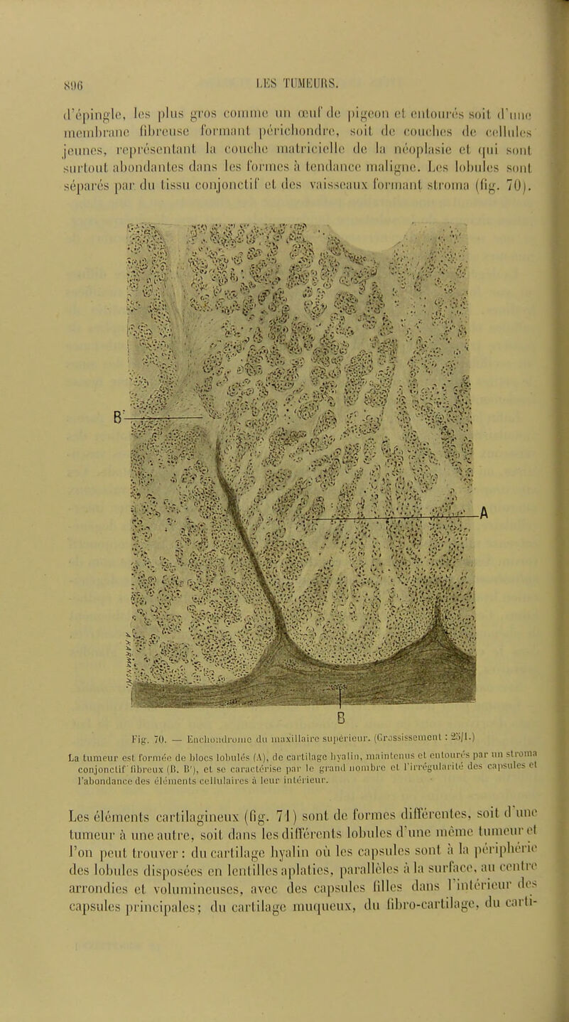 d’^pingle, les plus gros commc un ocmfde pigeon et enloures soil d'niie membrane fibrcuse formant perichondre, soil de conches de cellules jeunes, representant la couche matricicllc de la neoplasie et qui sent surtout abondantes dans les formes a tendance maligne. Los lobules sent separes par du tissu conjonctif et des vaisseaux formant stroma (fig. 70). Fig. 70. — Enchondromc du maxillaire superieur. (Crossisseinent: 2o/l.) La tumeur esl. formee de blocs lobules (A), dc cartilage hyalin, maintenus ct enloures par un stionia conjonctif fibreux (B. B'), et so caraclerise par Ic grand nombre el 1 irregularite des capsules el l’abondance des elements cellulaires ii leur inLerieur. Les elements cartilagineux (fig. 71) sont dc formes differentes, soit d une tumeur a une autre, soit dans les differents lobules d une memo tumeur et Ton pent trouver: du cartilage hyalin ou les capsules sont a la peripheric des lobules disposees cn lentilles aplaties, paralleles a la surface, an ccntie arrondies el volumincuses, avee des capsules lilies dans 1 inlerieiu de> capsules principales; du cartilage muqueux, du fibro-cartilage, du carti-