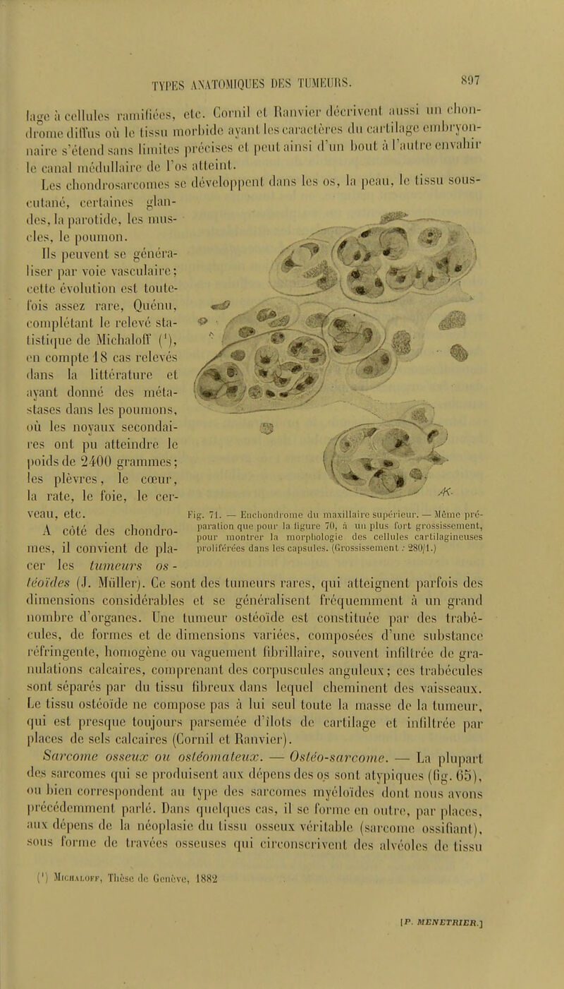 lagc a cellules ramiliees, ole. Cornil et Ranvier decrivcnt aussi un chon- drome diffus on lo tissu morhide ayant les caracteres do cartilage embryon- maire s’etend sans limites precises cl pculainsi d’un bout a I’aulrc envahir le canal medullaire do 1 os atteint. bes chondrosarcomes sc developpenl dans los os, la peau, le lissu sous- cutane, ccrtaines glan- ties, la parotide, les mus- ... cles. le poumon. Ils peuvent sc genera- liser par voie vasculairc; cette evolution csl toutc- fois assez rare, Quenu, completant le relevc sta- tistique de MichalofT (*), t'u compte 18 cas releves dans la litterature et ayant donne des meta- stases dans les poumons, oil les noyaux secondai- res ont pu atteindre le poidsde 2400 grammes; les plevres, le cceur, la rate, le foie, le cer- veau, etc. A cote des chondro- incs, il convicnt de pla- cer les tumeurs os - tdoides (J. Muller). Cc sont des tumeurs rarcs, qui atteignent parfois des dimensions considerables et sc generalisent frequemment a un grand nornbre d’organes. line tumeur osteoide est constituce par des trabe- cules, de formes et de dimensions variecs, composees d’unc substance refringente, bomogenc ou vaguement fibrillaire, souvent infiltree de gra- nulations calcaires, comprenanl des corpuscules anguleux; ces trabecules sont separcs par du tissu fibreux dans lcquel clieminent des vaisscaux. le tissu osteoide ne compose pas a lui seul toute la masse de la tumeur, qui est presque toujours parsemee d’ilots de cartilage et infiltree par places de scls calcaires (Cornil et Ranvier). Sarcome osseux ou osteomateux. — Ostdo-sarcome. — La plupart des sarcomcs qui sc produisent aux depens des os sont atypiques (lig. (35), ou bicn correspondent au type des sarcomcs myeloides dont nous avons precedemment parle. Dans quelqucs cas, il sc forme en outre, par places, aux depens de la neoplasic du tissu osseux veritable (sarcome ossifiant), sous forme de Iravecs osseuses qui circonscrivcnt des alveoles de tissu Fig. 71. — Encliondrome du maxillaire superieur. — Mfirae pre- paralion que pour la figure 70, a uu plus l’ort grossissement, pour montrer la morphologic des cellules carlilagineuses proliferees dans les capsules. (Grossissement: 280/1.) 0 Michaloff, These do Geneve, 188‘2