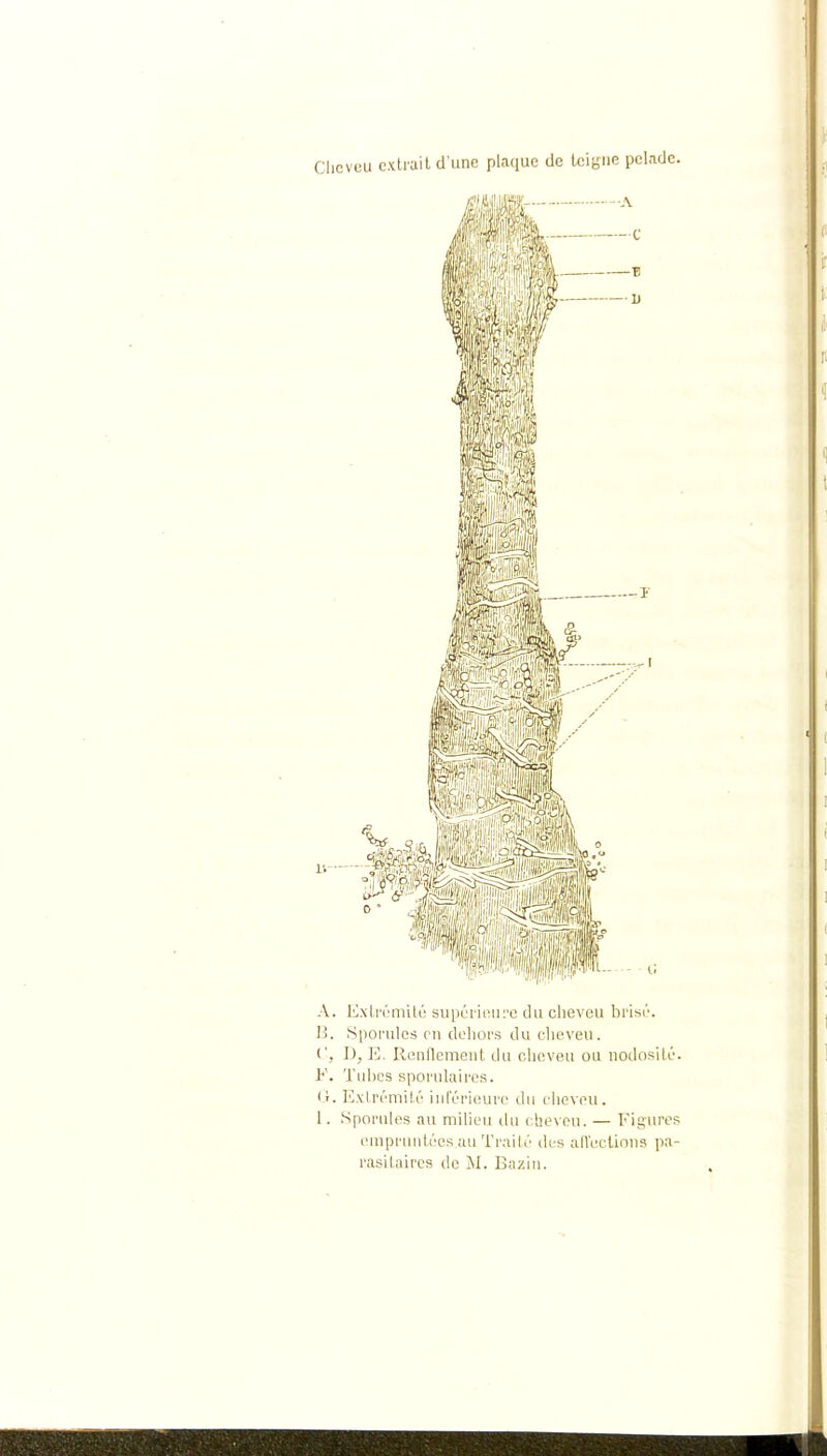 Clicveu extrait d'une plaque de teigne pelade. r. A. liixli'éniité supériinii'c du cheveu brisL'. U. Spoi'ulcs en dehors du cheveu. (', I), Iv RiMiflcmcnt du cheveu ou nodosité. F. Tubes sporulaires. (-t. Extrémité inl'érieure du clieveu. 1. Sporules au milieu du cheveu. — Figures enipi'iudées au Traité des afl'uclions pa- rasitaires de M. Bazin.
