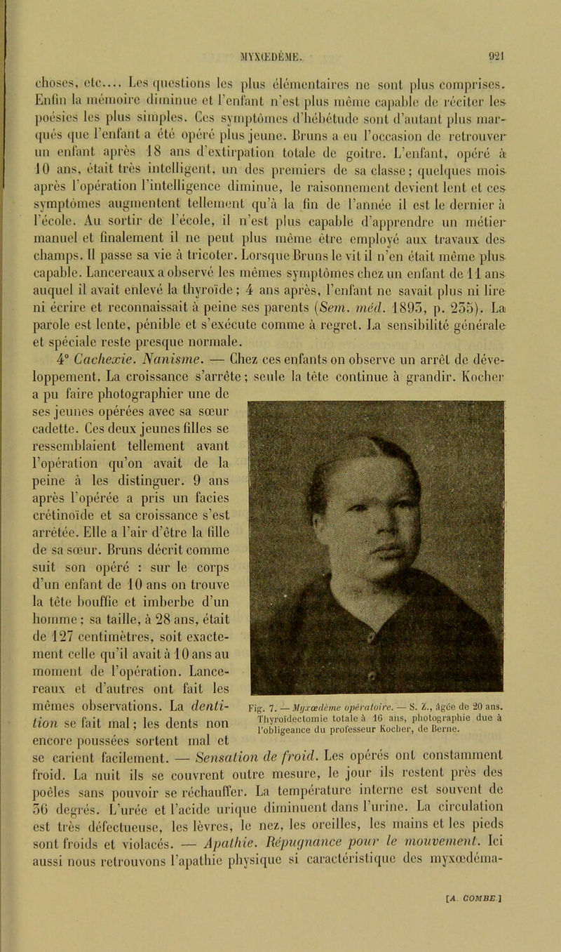 cliosos, etc— Los (|iicslions Ics pins eloinonlaircs nc soul |)liis comprises. Enliii la momoiro diminue ct rcnlanl n’esl plus mome capahle de rocitor Ics- poesies les plus simples. Ces sympldmes (riiehetudc soul (rautaul plus mar- (pios (pie I’enlant a titij opcji'is plus jeune. linms a eu I’occasion de rclrouver uu enlaut apres 18 ans d’extirpatiou lolalc de goitre. L’enl'ant, opcirci ti 10 ans. (,‘tait triis intelligent, un dcs premiers de sa classc; (piclipies mois^ apres I’opiiration I’intelligencc diminue, Ic raisonnement devient lent ct ces symptomes augmentent tellcment qu’a la fin de I’annc'e il cst le dernier a Fticole. All sortir de I’ecole, il n’esl plus capable d’apprendre un nuitiei inanuel et fmalement il nc pent plus nieme etre cmploy(3 aux travaux dcs champs. Il passe sa vie a tricoter. Lorsque Bruns Icvitil n’en etait meme plus capable. Lancercaux a observci les niemes symptomes chez un cnl'ant de 11 ans auquel il avail enlevi* la thyroide; 4 ans apres, I’enfant ne savait plus ni lire ni (icrire et reconnaissait a peine ses parents (Scm. 1895, p. 255). La parole esl lente, penible et s’executc comme a regret. La sensibilite gemirale et speciale reste presque normale. 4“ Cachexie. Nanisme. — Chez ces enfants on observe un arret de deve- loppement. La croissance s’arrete; scule la tiHe continue a grandir. Koeber a pu faire photographier une de ses jeunes operees avec sa socur cadette. Ces deux jeunes filles se resscmblaient tellement avant I’operation qu’on avail de la peine a les distinguer. 9 ans apres I’opiiree a pris un facies crf'tino'ide et sa croissance s’est arret(?e. Elle a I’air d’ijtre la lille de sa soeur. Bruns d(icrit comme suit son op(5r(3 : sur le corps d’un enfant de 10 ans on trouve la tete bouffie et imberbe d’un homme; sa taille, a 28 ans, etait de 127 centimetres, soil exacte- ment cede qu’il avail a 10 ans an moment de 1’opf‘ration. Lance- reaux ct d’autres ont fait les memes observations. La denti- tion se fait mal; les dents non encore poussiies sortent mal et sc carient facilement. — Sensation de froid. Les op(5r(is ont constamment froid. La nuit ils se couvrent outre mesure, le jour ils rcstent pres dcs poeles sans pouvoir sc rechauffer. La tempiiraturc interne cst souvent de 56 degres. L’un;c et I’acide urique diminuent dans 1 urine. La circulation est Ires di-fectucuse, les levrcs, le nez, les orcillcs, les mains et les pieds sont froids ct violaciis. — Apatliie. RepiKjnance pour le mouvement. lei aussi nous rclrouvons I’apalhic physique si caracliiristiipie des myxeediima- Fig. 7. — Mi/xcedeme oi>ivatoirc. — S. Z., igue de 20 ans. Thyroideclomie tolale 16 ans, pliotograpliie due 4 I’obligeance du prolesseur Koclier, de Berne.