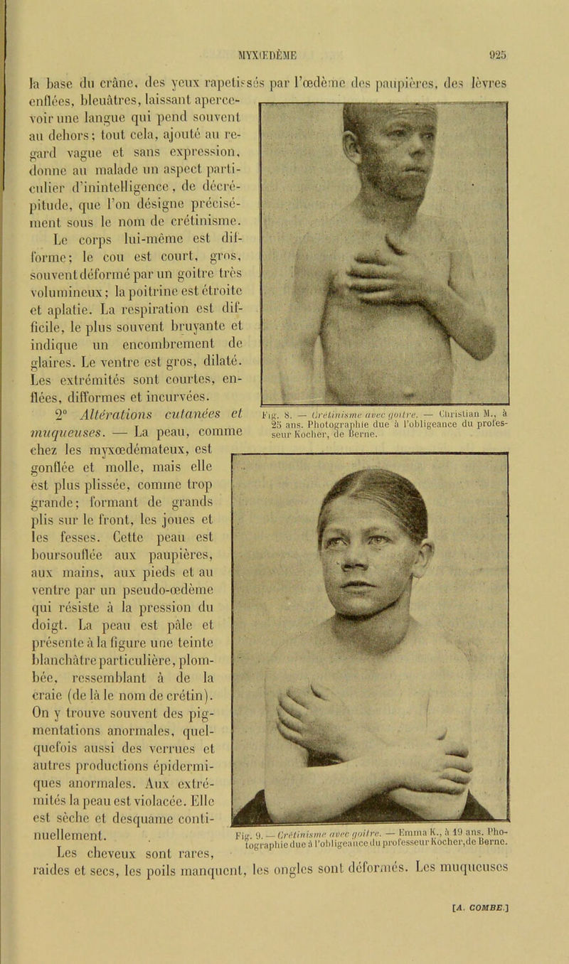 Fl^■. 8. — Ci't'liiiisnu' (iDcc <ioilre. — Clirislian M., a 23 ans. Photograpliie clue a I’obligeance du prol'es- seur Kocher, cle lienie. la base du crane, dcs yciix rapelisses par roedetnc des paiipiercs, dcs levres cnllees, lilcuatrcs, laissant apcrce- voir line languc qni pend sonvcnl an deliors; tout ccia, ajoule au re- gard vague ct sans expression, donnc au lualadc un aspect parti- culier d’inintclligencc, de decre- ])itude, epic Ton designe precise- incut sous le noin de cretinisine. be corps lui-niemc cst dil- Ibrinc; le cou cst court, gros, souvent deforme par un goitre tres volumineux; la poitrine est ctroitc ct aplatie. La respiration est dif- ficile, le plus souvent bruyantc et indique un encombrement de glaires. Le ventre cst gros, dilate. Les extremites sont courtes, en- flees, difformes et incurvees. 2® Alterations cutanees et mnquevses. — La peau, coinme chez les niyxoedemateux, est gonflee et niolle, mais elle est plus plissee, comme trop grande; formant de grands plis sur le front, les joues ct les fesscs. Cette peau est boursouflee aux paupicres, aux mains, aux pieds ct au ventre par un pseudo-cedeme qui resisle a la pression du doigt. La peau cst pale et presente a la figure une teinte blancliatreparticulierc, plom- bee. rcssemblant a de la craie (de la le nom de cretin). On y trouve souvent des pig- mentations anormalcs, qucl- quefois aussi dcs vermes ct autres productions e[)idermi- ques anormalcs. Aux extre- mites la peau est violaccc. Elle est scebe ct desquame conti- nuellement. Les ebeveux sont rares, raidcs ct secs, les poils manquent, les onglcs sont dcfornics. Les muqucuscs ,T 9 CriHinhtnc avre t/oifre. — Kniina K., a 1.) ans. 1 ho- !ograpliieclucal’ol)ligea'iiccilu icmlesseur Kocher,de Berne.