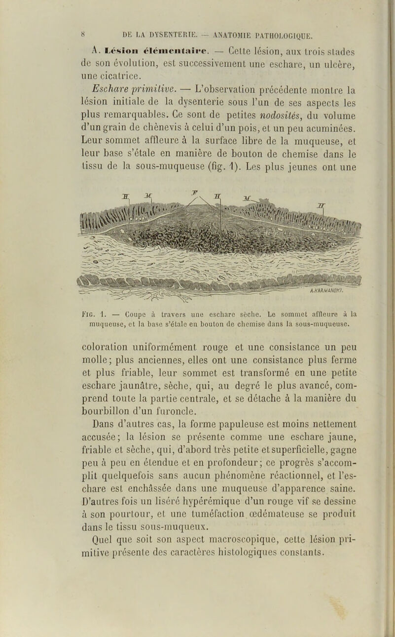 A. Lésion élémentaire. — Celle lésion, aux Irois slades de son évolution, est successivement une eschare, un ulcère, une cicatrice. Eschare primitive. — L’observation précédente montre la lésion initiale de la dysenterie sous l’un de ses aspects les plus remarquables. Ce sont de petites nodosités, du volume d’un grain de chènevis à celui d’un pois, et un peu acuminées. Leur sommet affleure à la surface libre de la muqueuse, et leur base s’étale en manière de bouton de chemise dans le tissu de la sous-muqueuse (fig. 1). Les plus jeunes ont une l'iG. 1. — Coupe travers une eschare sèche. Le sommet affleure à la muqueuse, et la base s’étale en bouton de chemise dans la sous-muqueuse. coloration uniformément rouge et une consistance un peu molle; plus anciennes, elles ont une consistance plus ferme et plus friable, leur sommet est transformé en une petite eschare jaunâtre, sèche, qui, au degré le plus avancé, com- prend toute la partie centrale, et se détache à la manière du bourbillon d’un furoncle. Dans d’autres cas, la forme papuleuse est moins nettement accusée; la lésion se présente comme une eschare jaune, friable et sèche, qui, d’abord très petite et superficielle, gagne peu à peu en étendue et en profondeur; ce progrès s’accom- plit quelquefois sans aucun phénomène réactionnel, et l’es- chare est enchâssée dans une muqueuse d’apparence saine. D’autres fois un liséré hypérémique d’un rouge vif se dessine à son pourtour, et une tuméfaction œdémateuse se produit dans le tissu sous-muqueux. Quel que soit son aspect macroscopique, celte lésion pri- mitive présente des caractères histologiques constants.