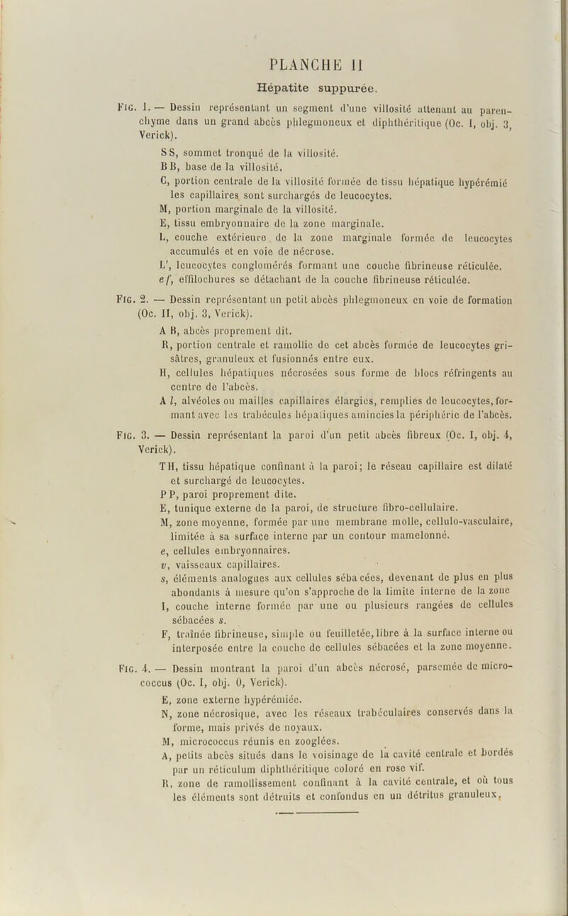 Hépatite suppurée. Fig. 1. — Dessin représentant un segment d’une villosité attenant au paren- chyme dans un grand abcès plilegmoneux et diphthérilique (Oc. 1, obj. U, Verick). SS, sommet tronqué de la villosité. B B, base de la villosité. C, portion centrale de la villosité formée de tissu hépatique hypérémié les capillaires sont surchargés de leucocytes. M, portion marginale de la villosité. E, tissu embryonnaire de la zone marginale. L, couche extérieure de la zone marginale formée de leucocytes accumulés et en voie de nécrose. L', leucocytes conglomérés formant une couche fibrineuse réticulée. ef, effilochures se détachant de la couche fibrineuse réticulée. Fig. 2. — Dessin représentant un petit abcès plilegmoneux en voie de formation (Oc. Il, obj. 3, Verick). A B, abcès proprement dit. B, portion centrale et ramollie de cet abcès formée de leucocytes gri- sâtres, granuleux et fusionnés entre eux. H, cellules hépatiques nécrosées sous forme de blocs réfringents au centre de l’abcès. A l, alvéoles ou mailles capillaires élargies, remplies de leucocytes, for- mant avec les trabécules hépatiques amincies la périphérie de l’abcès. Fig. 3. — Dessin représentant la paroi d’un petit abcès fibreux (Oc. 1, obj. i, Verick). TII, tissu hépatique confinant à la paroi; le réseau capillaire est dilaté et surchargé de leucocytes. PP, paroi proprement dite. E, tunique externe de la paroi, de structure fibro-cellulaire. M, zone moyenne, formée par une membrane molle, cellulo-vasculaire, limitée à sa surface interne par un contour mamelonné. e, cellules embryonnaires. v, vaisseaux capillaires. s, éléments analogues aux cellules sébacées, devenant de plus en plus abondants à mesure qu’on s’approche de la limite interne de la zone I, couche interne formée par une ou plusieurs rangées de cellules sébacées s. F, traînée fibrineuse, simple ou feuilletée, libre à la surface interne ou interposée entre la couche de cellules sébacées et la zone moyenne. Fig. f. — Dessin montrant la paroi d’un abcès nécrosé, parsemée de micro- coccus (Oc. I, obj. U, Verick). E, zone externe hypérémiéc. N, zone nécrosiquc, avec les réseaux trabéculaires conservés dans la forme, mais privés de noyaux. M, micrococcus réunis en zooglées. A, petits abcès situés dans le voisinage de la cavité centrale et bordés par un réticulum diphthérilique coloré en rose vil. B, zone de ramollissement confinant à la cavité centrale, et où tous les éléments sont détruits et confondus en un détritus granuleux,