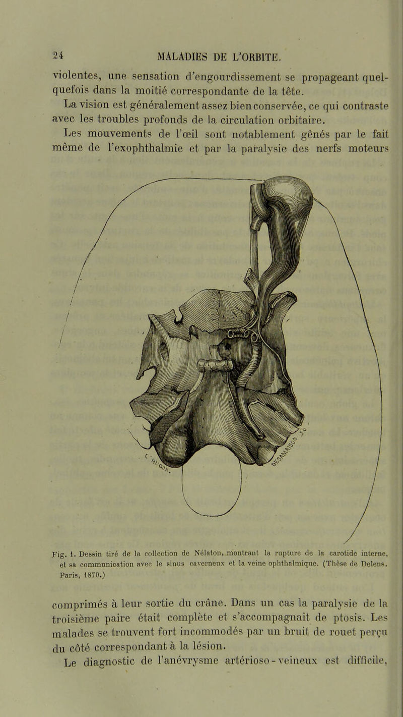 violentes, une sensation d'engourdissement se propageant quel- quefois dans la moitié correspondante de la tête. La vision est généralement assez bien conservée, ce qui contraste avec les troubles profonds de la circulation orbitaire. Les mouvements de F œil sont notablement gênés par le fait même de l'exophthalmie et par la paralysie des nerfs moteurs Fig. !• Dessin tiré de la collection de Nélaton, montrant la rupture de la carotide interne, et sa communication avec le sinus caverneux et la veine ophtlialmiqne. (Thèse de Delens. Paris, 1870.) comprimés à leur sortie du crâne. Dans un cas la paralysie de la troisième paire était complète et s'accompagnait de ptosis. Les malades se trouvent fort incommodés par un bruit de rouet perçu du côté correspondant à la lésion. Le diagnostic de l'anévrysme artérioso-veineux est difficile,