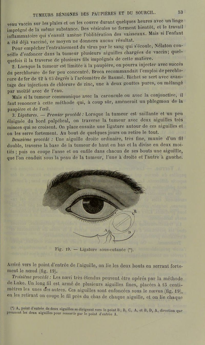 veau vaccin sur les plaies et on les couvre durant quelques heures avec un linge imprégné de la même substance. Des vésicules se forment bientôt, et le travail inflammatoire qui s'ensuit amène Toblitéralion des vaisseaux. Mais si l'enfant a été déjà vacciné, ce moyen ne donnera aucun résultat. Pour empêcher l'entraînement du virus par le sang qui s'écoule, Nélaton con- seille d'enfoncer dans la tumeur plusieurs aiguilles chargées de vaccin; quel- quefois il la traverse de plusieurs fils imprégnés de celte matière. 2. Lorsque la tumeur est limitée à la paupière, on pourra injecter avec succès du perchlorure de fer peu concentré. Broca recommandait l'emploi de perchlo- rure de fer de 12 à 15 degrés à l'aréomètre de Baumé. Richet se sert avec avan- tage des injections de chlorure de zinc, une à deux gouttes pures, ou mélangé par moitié avec de l'eau. Mais si la tumeur communique avec la caroncule ou avec la conjonctive, il faut renoncer à cette méthode qui, à coup sûr, amènerait un phlegmon de la paupière et de l'oeil. 3. Ligatures. — Vremier 'procédé : Lorsque la tumeur est saillante et un peu éloignée du bord palpébral, on traverse la tumeur avec deux aiguilles très minces qui se croisent. On place ensuite une ligature autour de ces aiguilles et on les serre fortement. Au bout de quelques jours on retire le tout. Deuxième procédé : Une aiguille droite ordinaire, très fine, munie d'un fil double, traverse la base de la tumeur de haut en bas et la divise en deux moi- tiés ; puis on coupe l'anse et on enfile dans chacun de ses bouts une aiguillle, que l'on conduit sous la peau de la tumeur, l'une à droite et l'autre à gauche. Arrivé vers le point d'entrée de l'aiguille, on lie les deux bouts eu serrant forte- ment le nœud (fig. 19). Troisième procédé: Les nœvi très étendus peuvent être opérés par la méthode de Luke. Un long fil est armé de plusieurs aiguilles fines, placées à 15 centi- mètres les unes (fes autres. Ces aiguilles sont enfoncées sous le nœvus (fig. 19), en les retirant on coupe le fil près du chas de chaque aiguille, et on lie chaque I Fig, 19. — Ligature sous-cutanée (*). dirigeant vers le point B ; B, C, A, et B, D, A, direction )ar le point d'entrée A. que