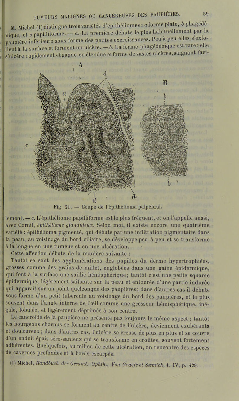 M Michel (1) dislingue trois variétés d'épilhéliomes : fi forme plate, i phagédé- nique, et e papilUforme. - a. La première débute le plus habituelleinenl par la paupière inférieure sous forme des petites excroissances. Peu a peu elles s exlo- lient à la surface et forment un ulcère. - 6. La forme phagédénique est rare ; elle s'ulcère rapidement et gagne en étendue et forme dévastes ulcères, saignant faci- A (1 Fig. 21 — Coupe de l'épithélioiua palpébral. li ment. — c. L'épilhéliome papilliforme est le plus fréquent, et on l'appelle aussi, avec Cornil, épithéliome glanduleux. Selon moi, il existe encore une quatrième variété : épilhélioma pigmenté, qui débute par une infiltration pigmentaire dans la peau, au voisinage du bord ciliaire, se développe peu à peu et se transforme à la longue en une tumeur et en une ulcération. Cette affection débute de la manière suivante : Tantôt ce sont des agglomérations des papilles du derme hypertrophiées, grosses comme des grains de millet, englobées dans une gaine épidermique, qui font à la surface une saillie hémisphérique; tantôt c'est une petite squame épidermique, légèrement saillante sur la peau et entourée d'une partie indurée qui apparaît sur un point quelconque des paupières; dans d'autres cas il débute sous forme d'un petit tubercule au voisinage du bord des paupières, et le plus souvent dans l'angle interne de l'œil comme une grosseur hémisphérique, iné- gale, lobulée, et légèrement déprimée à son centre. Le cancroïde de la paupière ne présente pas toujours le même aspect : tantôt les bourgeons charnus se forment au centre de l'ulcère, deviennent exubérants et douloureux ; dans d'autres cas, l'ulcère se creuse de plus en plus et se couvre d'un enduit épais séro-sanieux qui se transforme en croûtes, souvent fortement adhérentes. Quelquefois, au milieu de celte ulcération, on rencontre des espèces de cavernes profondes et à bords escarpés. (1) Michel, Handbuch der Gesamt. Ophth., Von Graefeet Samich, t. IV, p. 429.