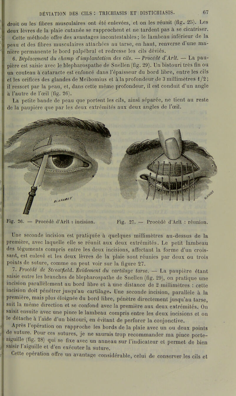 droit ou les fibres musculaires ont été enlevées, et on les réunit (fig. 25). Les deux lèvres de la plaie cutanée se rapprochent et ne lardent pas à se cicatriser. • Celte méthode offre des avantages incontestables ; le lambeau inférieur de la peau et des fibres musculaires attachées au tarse, en haut, renverse d'une ma- nière permanente le bord palpébral et redresse les cils déviés. 6. Déplacement du champ d'implantation des cils. — Procédé d'Arlt. — La pau- pière est saisie avec le blepharospathe de Snellen (fig. 29). Un bistouri très fin ou un couteau à cataracte est enfoncé dans l'épaisseur du bord libre, entre les cils et les orifices des glandes de Meibomius et à la profondeur de 3 millimètres 1/2; il ressort par la peau, et, dans cette même profondeur, il est conduit d'un angle à l'autre de l'œil (fig. 26). La petite bande de peau que portent les cils, ainsi séparée, ne lient au reste de la paupière que par les deux extrémités aux deux angles de l'œil. Fig. 26. — Procédé d'Arlt : incision. Fig. 27. — Procédé d'Arlt : réunion. Une seconde incision est pratiquée à quelques milHmèlres au-dessus de la première, avec laquelle elle se réunit aux deux extrémités. Le petit lambeau des téguments compris entre les deux incisions, affectant la forme d'un crois- sant, est enlevé et les deux lèvres de la plaie sont réunies par deux ou trois points de suture, comme on peut voir sur la figure 27. 7. Procédé de Streatfield. Évidement du cartilage tarse. — La paupière étant saisie entre les branches de blepharospathe de Snellen (fig. 29), on pratique une incision parallèlement au bord libre et à une distance de 2 millimètres : cette incision doit pénétrer jusqu'au cartilage. Une seconde incision, parallèle à la première, mais plus éloignée du bord libre, pénètre directement jusqu'au tarse, suit la même direction et se confond avec la première aux deux extrémités. On saisit ensuite avec une pince le lambeau compris entre les deux incisions et on le détache à l'aide d'un bistouri, en évitant de perforer la conjonctive. Après l'opération on rapproche les bords de la plaie avec un ou deux points de suture. Pour ces sutures, je ne saurais trop recommander ma pince porte- aiguille (fig. 28) qui se fixe avec un anneau sur l'indicateur et permet de bien saisir l'aiguille et d'en exécuter la suture. Cette opération offre un avantage considérable, celui de conserver les cils et