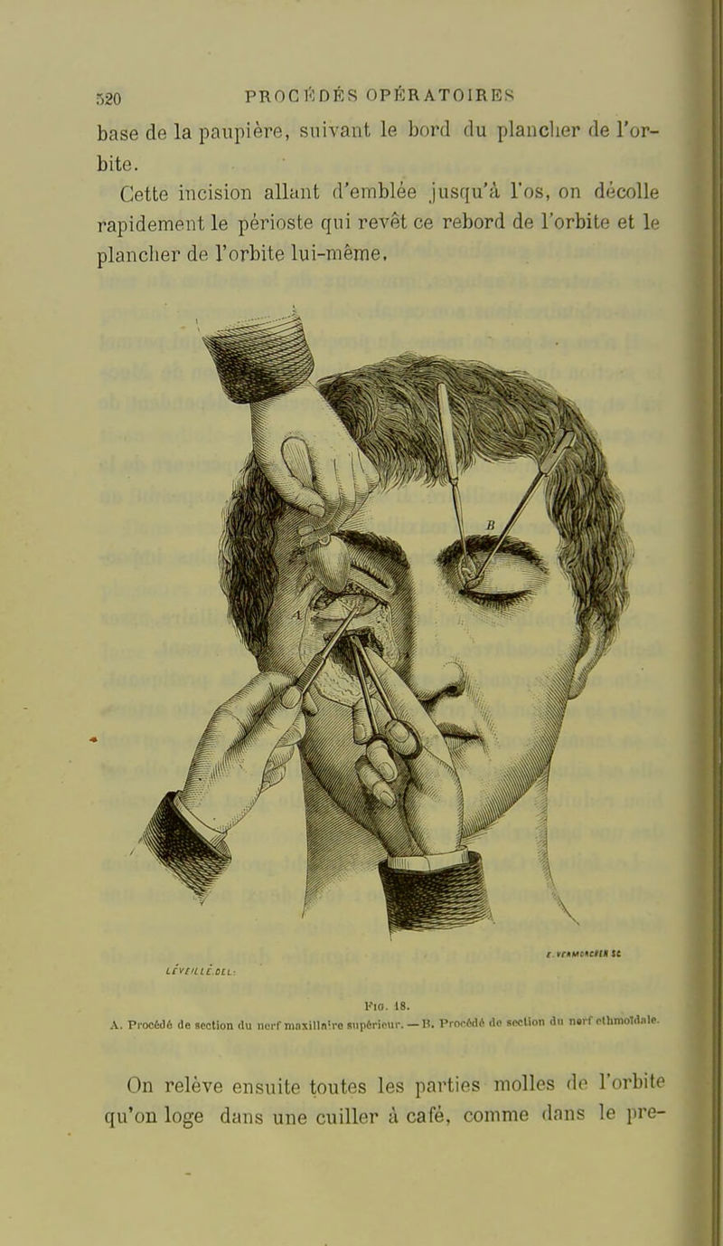 base de la paupière, suivant le bord du plancher de l'or- bite. Cette incision allant d'emblée jusqu'à l'os, on décolle rapidement le périoste qui revêt ce rebord de l'orbite et le plancher de l'orbite lui-même. t. tciiuMcn» te LCVCILICULL: V\o. 18. A. Procédé de section du nerf maxilln'.ro siipéricur. — lî. Procédé do scclion du nerf clhmoTdnle. On relève ensuite toutes les parties molles de l'orbite qu'on loge dans une cuiller à café, comme dans le pre-