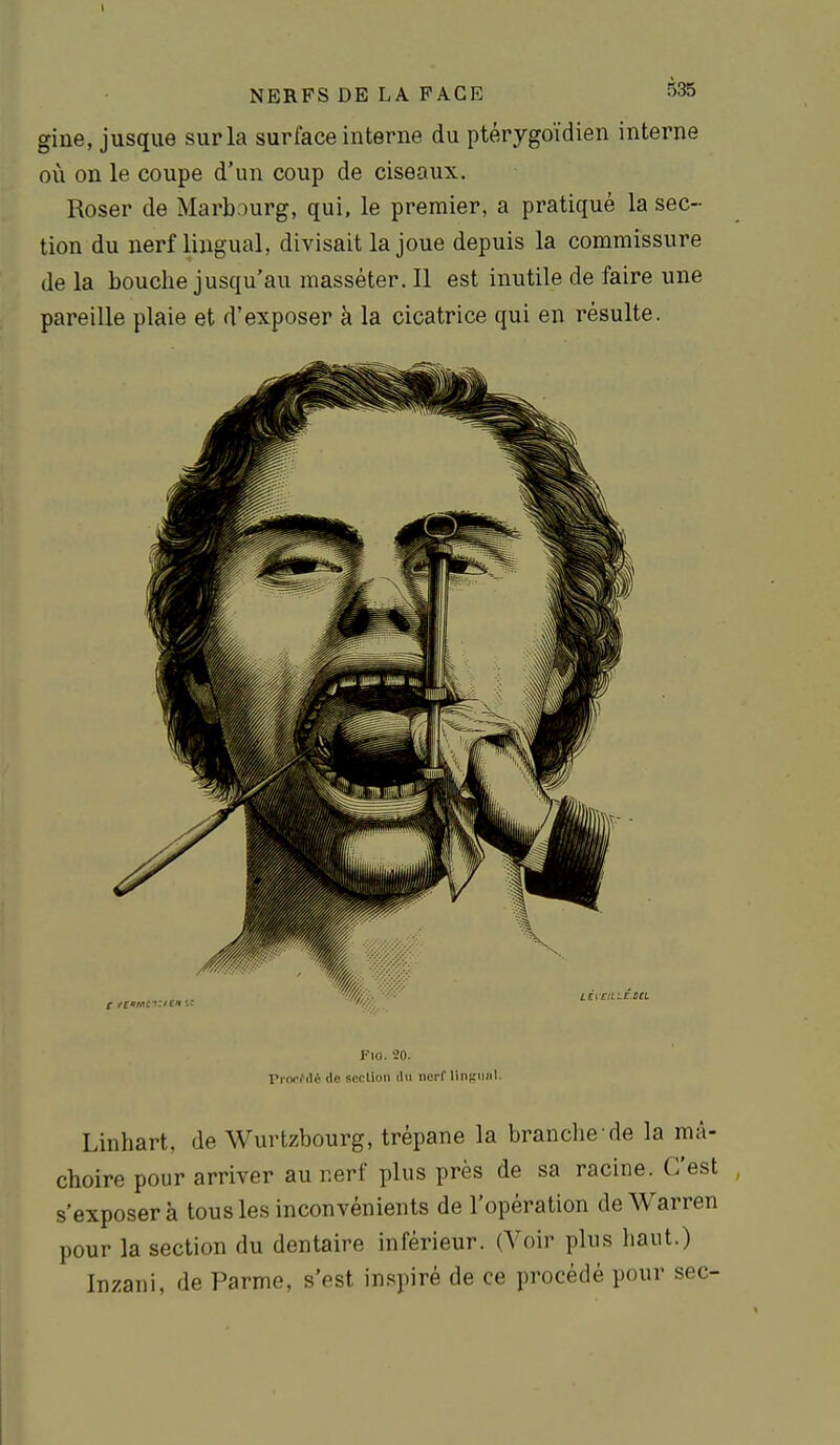 gine, jusque sur la surface interne du ptérygoïdien interne où on le coupe d'un coup de ciseaux. Roser de Marbourg, qui, le premier, a pratiqué la sec- tion du nerf lingual, divisait la joue depuis la commissure de la bouche jusqu'au masséter. Il est inutile de faire une pareille plaie et d'exposer à la cicatrice qui en résulte. Fio. 20. Procfdé de sccllon du nerf llnf.'iiiil. Linhart, de Wurtzbourg, trépane la branche de la mâ- choire pour arriver au nerf plus près de sa racine. C'est , s'exposer à tous les inconvénients de l'opération de Warren pour la section du dentaire inférieur. (Voir plus haut.) Inzani, de Parme, s'est in.'^piré de ce procédé pour sec-