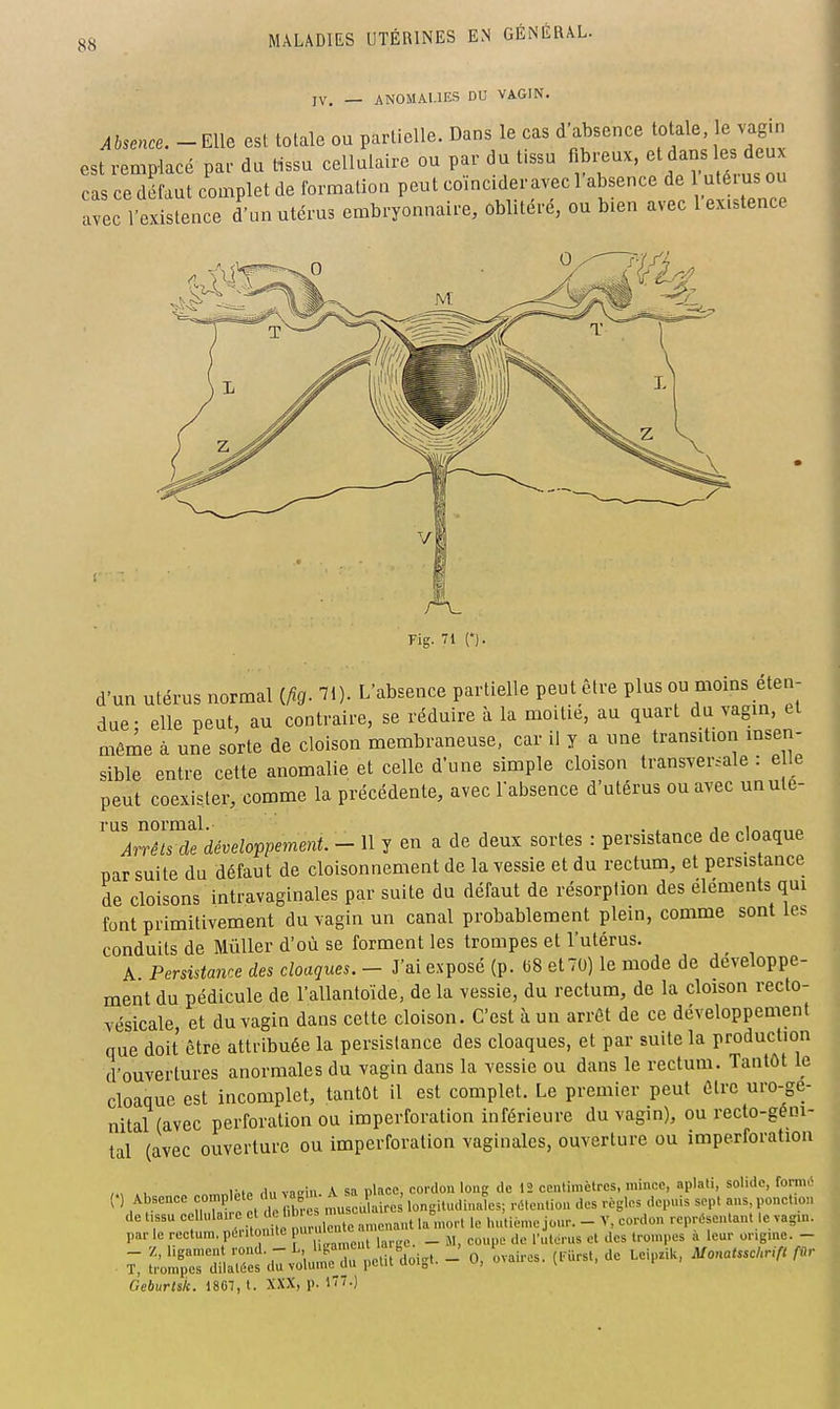 jV. — ANOMALIES DU VAGIN. Absence. - Elle est totale ou partielle. Dans le cas d'absence totale, le vagin est remplacé par du Hssu cellulaire ou par du tissu fibreux, les d«- cas ce défaut complet de formation peut coïncider avec 1 absence de 1 utéius ou avec 1 existence d'un utérus embryonnaire, oblitéré, ou bien aveci existence Fig. 71 C). d'un utérus normal (As- ^D- L'absence partielle peut être plus ou aïoins éten- due; elle peut, au contraire, se réduire à la moitié, au quart du vagin, et même à une sorte de cloison membraneuse, car il y a une transition insen- sible entre cette anomalie et celle d'une simple cloison transversale : e 1 e peut coexister, comme la précédente, avec l'absence d'utérus ou avec unule- ' ArrTlTcle développement. - 11 y en a de deux sortes : persistance de cloaque par suite du défaut de cloisonnement de la vessie et du rectum, et persistance de cloisons intravaginales par suite du défaut de résorption des éléments qui font primitivement du vagin un canal probablement plein, comme sont les conduits de MûUer d'où se forment les trompes et l'utérus. _ A Persistatice des cloaques. - J'ai exposé (p. C8 et 70) le mode de développe- ment du pédicule de l'allantoïde, de la vessie, du rectum, de la cloison recto- vésicale, et du vagin dans cette cloison. C'est à un arrêt de ce développement que doit être attribuée la persistance des cloaques, et par suite la production d'ouvertures anormales du vagin dans la vessie ou dans le rectum. Tantôt le cloaque est incomplet, tantôt il est complet. Le premier peut être uro-ge- nital (avec perforation ou imperforation inférieure du vagin), ou recto-géni- tal (avec ouverture ou imperforation vaginales, ouverture ou imperforatiou r.„ ,l„ vnirin A sa nlacc, cordon Iour de 12 centimètres, mince, aplati, solide, forme' (.) Absence ^.^P'f '  ^^^^^^^^ X rc longitudinales; racntion des règles depuis sept ans, ponction de t.ssu <=f''-^'^^f ' . ^^^^^^^^^^ la .nort le hutieme jour. - V, cordon représentant le vagm. par le rectum, pé.itomte «r- _ j, l'utorus et des trompes a leur ongme. - . 7, :;irriai^^.:v'o'lur d.: Pdit^doigt. - O, ovai-es. (t^Urst. de Leip.iU, MonaUsc^Hf. fnr Geburls/c. 18G7, t. XXX, p. iTT.)