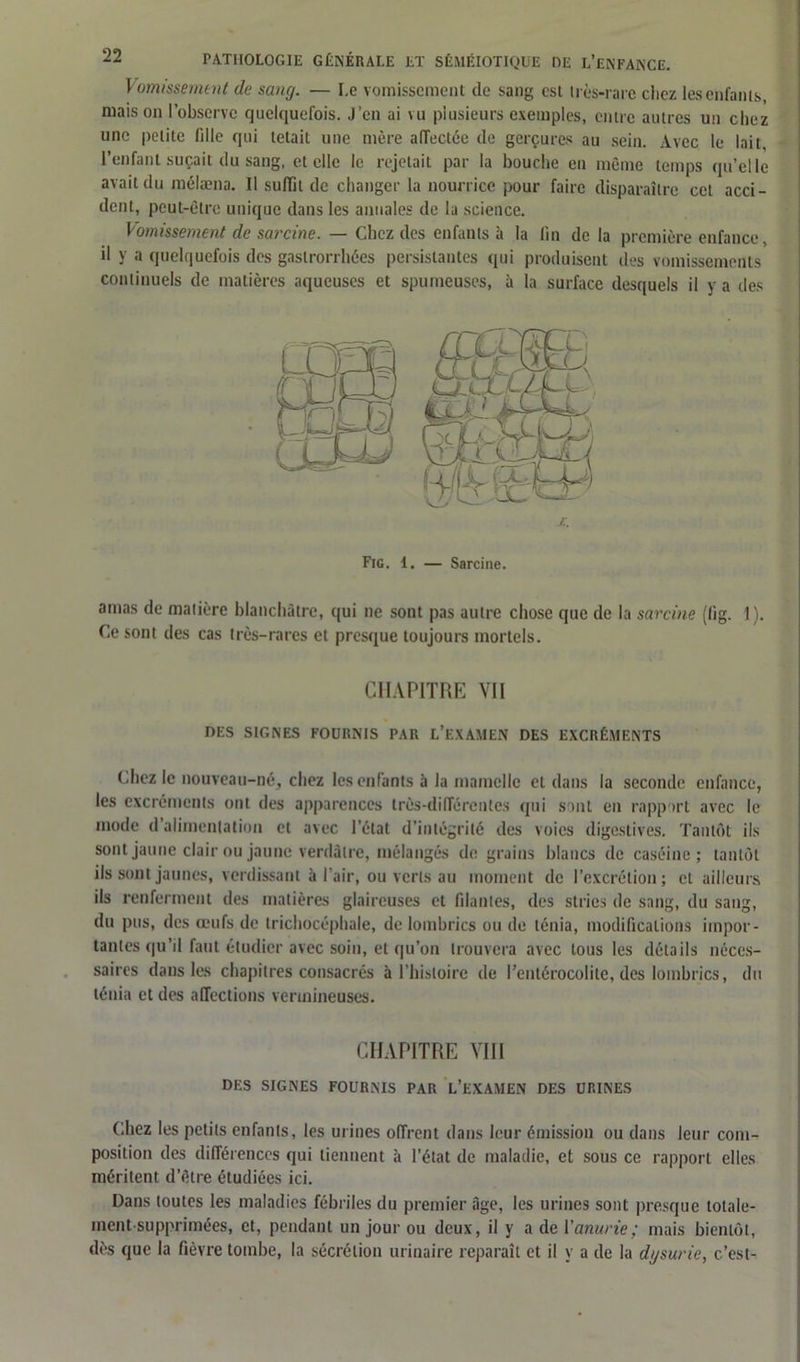 Vomissement de sang. — I.e vomissement de sang est très-rare chez les enfants, maison l’observe quelquefois. J’en ai vu plusieurs exemples, entre autres un chez une petite fille qui tétait une mère affectée de gerçures au sein. Avec le lait, l’enfant suçait du sang, et elle le rejetait par la bouche en même temps qu’elle avait du mélæna. Il suffit de changer la nourrice pour faire disparaître cet acci- dent, peut-être unique dans les annales de la science. Vomissement de sarcine. — Chez des enfants à la fin de la première enfance, il y a quelquefois des gaslrorrhées persistantes qui produisent des vomissements continuels de matières aqueuses et spumeuses, à la surface desquels il y a des Fig. 1. — Sarcine. amas de matière blanchâtre, qui ne sont pas autre chose que de la sarcine (lig. 1). Ce sont des cas très-rares et presque toujours mortels. CHAPITRE Vil DES SIGNES FOURNIS PAR L’EXAMEN DES EXCRÉMENTS Chez le nouveau-né, chez les enfants à la mamelle et dans la seconde enfance, les excréments ont des apparences très-différentes qui sont eu rapport avec le mode d alimentation et avec l’état d’intégrité des voies digestives. Tantôt ils sont jaune clair ou jaune verdâtre, mélangés de grains blancs de caséine; tantôt ils sont jaunes, verdissant à l’air, ou verts au moment de l’excrétion; et ailleurs ils renferment des matières glaireuses et filantes, des stries de sang, du sang, du pus, des œufs de trichocéphale, de lombrics ou de ténia, modifications impor- tantes qu’il faut étudier avec soin, et qu’on trouvera avec tous les détails néces- saires dans les chapitres consacrés à l’histoire de l’entérocolite, des lombrics, du ténia et des affections vermineuses. CHAPITRE VIII DES SIGNES FOURNIS PAR L’EXAMEN DES URINES Chez les petits enfants, les urines offrent dans leur émission ou dans leur com- position des différences qui tiennent à l’état de maladie, et sous ce rapport elles méritent d’être étudiées ici. Dans toutes les maladies fébriles du premier âge, les urines sont presque totale- ment supprimées, et, pendant un jour ou deux, il y a de Vanurie; mais bientôt, dès que la fièvre tombe, la sécrétion urinaire reparaît et il y a de la dgsurie, c’est-