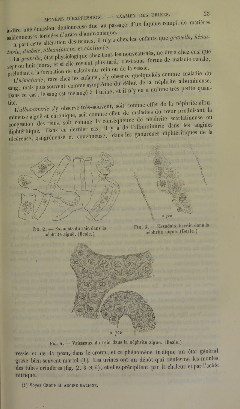 moyens d'expression. — examen des urines. 2-. Mire une émission douloureuse due au passage d'un liquide rempli de mal,-'es les enfants que grave®, héma- turie, diabète, albuminurie, et : nouveau-nés, ne dure chez eux que '>is “d: fr s°usctorme de *na,adie riale’ préludant à la formation de calculs du re■ -“e fois comme maladie du L'hématurie, rare chez les enfants sy ob e. _ 1 albumi„euse. sang, .nais plus souvent comme sywpU>m du P lrès.pelile quan_ Dans ce cas, le sang est mélangé a 1 mine, et n n y 1 tité. , cn;t rnmmp effet de la néphrite albu- L ■albuminurie s'y observe tres-souven, soi, comme eBc^ ^ mineuse aiguë et chronique, soit connue néphrite scarlatineuse ou congestion des reins, soit comme a da„s les angines diphtéritique. Dans ce demie. > , * gangrènes diphtéritiques de la ulcéreuse, gangréneuse et couenneuse, dans les gan0 t 3, _ Exsudais du rein dans la ncphrile aiguë. (Beale.) Fig. 2. — Exsudats du rein dans la néphrite aiguë. (Beale.) EIG_ 4,_ Vaisseaux du rein dans la néphrite aiguë. (Beale.) vessie et de la peau, dans le croup, et ce phénomène indique un état général grave bien souvent mortel (1). Les urines ont un dépôt qui renferme les moules des tubes urinifères (fig. 2, 3 et ù), et elles précipitent par la chaleur et par l’acide nitrique. (1) Voyez Croup et Angine maligne.