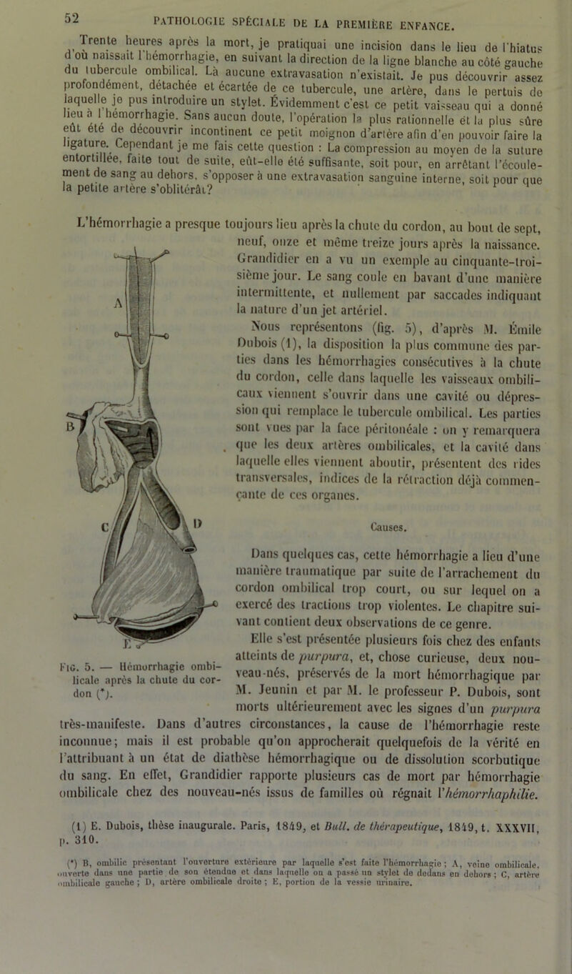 Trente heures après la mort, je pratiquai une incision dans le lieu de l'hiatus d ou naissait 1 hémorrhagie, en suivant la direction de la ligne blanche au côté gauche du tubercule ombilical. La aucune extravasation n'existait. Je pus découvrir assez profondément, detachee et écartée de ce tubercule, une artère, dans le pertuis do laquelle je pus introduire un stylet. Evidemment c’est ce petit vaisseau qui a donné beu a I hémorrhagie. Sans aucun doute, l’opération la plus rationnelle et la plus sûre eût été de découvrir incontinent ce petit moignon d’artère afin d’en pouvoir faire la ligature. Cependant je me fais cette question : La compression au moyen de la suture entortillée, faite tout de suite, eut-elle été suffisante, soit pour, en arrêtant l’ccoule- ment de sang au dehors, s’opposer à une extravasation sanguine interne, soit pour ctue la petite artère s’oblitérât? L’hémorrhagie a presque toujours lieu après la chute du cordon, au bout de sept, neuf, onze et même treize jours après la naissance. Grandidier en a vu un exemple au cinquante-troi- sième jour. Le sang coule en bavant d’une manière intermittente, et nullement par saccades indiquant la nature d’un jet artériel. Nous représentons (fig. 5), d’après AI. Émile Dubois (1), la disposition la plus commune des par- ties dans les hémorrhagies consécutives à la chute du cordon, celle dans laquelle les vaisseaux ombili- caux viennent s’ouvrir dans une cavité ou dépres- sion qui remplace le tubercule ombilical. Les parties sont vues par la face péritonéale : on y remarquera . que les deux artères ombilicales, et la cavité dans laquelle elles viennent aboutir, présentent des rides transversales, indices de la rétraction déjà commen- çante de ces organes. Causes. Dans quelques cas, cette hémorrhagie a lieu d’une manière traumatique par suite de l’arrachement du cordon ombilical trop court, ou sur lequel on a exercé des tractions trop violentes. Le chapitre sui- vant contient deux observations de ce genre. Elle s’est présentée plusieurs fois chez des enfants atteints de purpura, et, chose curieuse, deux nou- veau-nés, préservés de la mort hémorrhagique par M. Jeunin et par Al. le professeur P. Dubois, sont morts ultérieurement avec les signes d’un purpura très-manifeste. Dans d’autres circonstances, la cause de l’hémorrhagie reste inconnue; mais il est probable qu’on approcherait quelquefois de la vérité en l’attribuant à un état de diathèse hémorrhagique ou de dissolution scorbutique du sang. En effet, Grandidier rapporte plusieurs cas de mort par hémorrhagie ombilicale chez des nouveau-nés issus de familles où régnait Vhémorr/iaphilie. Fig. 5. — Hémorrhagie ombi- licale après la chute du cor- don (*j. (1) E. Dubois, thèse inaugurale. Paris, 1849, et Bull, de thérapeutique, 1849, t. XXXVII, p. 310. (*) (*) B, ombilic présentant l’ouverture extérieure par laquelle s’est faite l’hémorrhngie ; A, voine ombilicale, ouverte dans une partie do son étendue et dans laquelle on a passé no stylet de dedans en dehors ; C, artère ombilicale gauche; D, artère ombilicale droite; E, portion de la vessie urinaire.