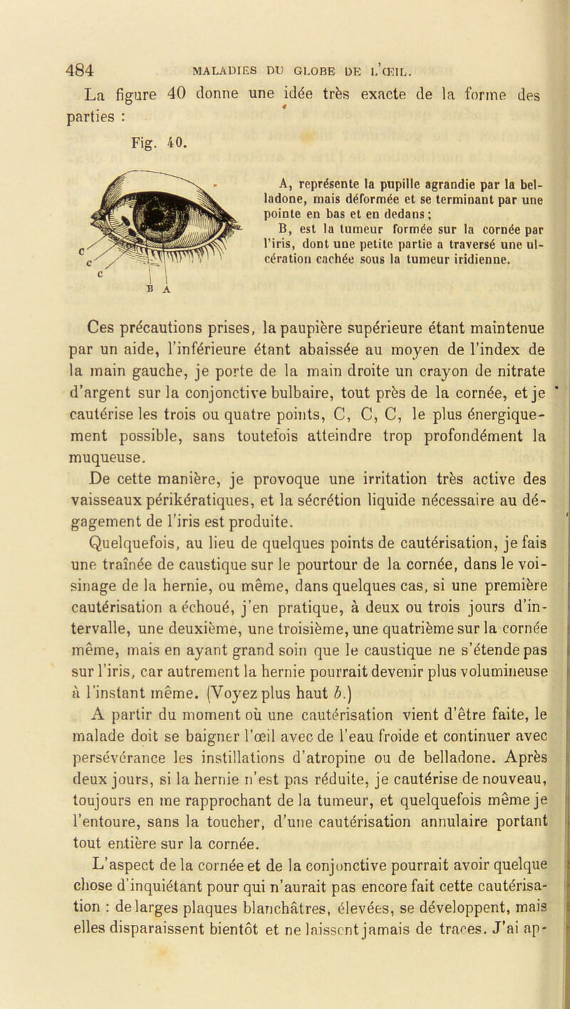 La figure 40 donne une idée très exacte de la forme des parties : Fig. 40. A, représente la pupille agrandie par la bel- ladone, mais déformée et se terminant par une pointe en bas et en dedans; B, est la tumeur formée sur la cornée par l’iris, dont une petite partie a traversé une ul- cération cachée sous la tumeur iridienne. Ces précautions prises, la paupière supérieure étant maintenue par un aide, l’inférieure étant abaissée au moyen de l’index de la main gauche, je porte de la main droite un crayon de nitrate d’argent sur la conjonctive bulbaire, tout près de la cornée, et je cautérise les trois ou quatre points, C, C, C, le plus énergique- ment possible, sans toutefois atteindre trop profondément la muqueuse. De cette manière, je provoque une irritation très active des vaisseaux périkératiques, et la sécrétion liquide nécessaire au dé- gagement de l’iris est produite. Quelquefois, au lieu de quelques points de cautérisation, je fais une traînée de caustique sur le pourtour de la cornée, dans le voi- sinage de la hernie, ou même, dans quelques cas, si une première cautérisation a échoué, j’en pratique, à deux ou trois jours d’in- tervalle, une deuxième, une troisième, une quatrième sur la cornée même, mais en ayant grand soin que le caustique ne s’étende pas sur l’iris, car autrement la hernie pourrait devenir plus volumineuse à l’instant même. (Voyez plus haut 6.) A partir du moment où une cautérisation vient d’être faite, le malade doit se baigner l'œil avec de l’eau froide et continuer avec persévérance les instillations d’atropine ou de belladone. Après deux jours, si la hernie n’est pas réduite, je cautérise de nouveau, toujours en me rapprochant de la tumeur, et quelquefois même je l’entoure, sans la toucher, d’une cautérisation annulaire portant tout entière sur la cornée. L’aspect de la cornée et de la conjonctive pourrait avoir quelque chose d’inquiétant pour qui n’aurait pas encore fait cette cautérisa- tion : de larges plaques blanchâtres, élevées, se développent, mais elles disparaissent bientôt et ne laissent jamais de traces. J’ai ap-