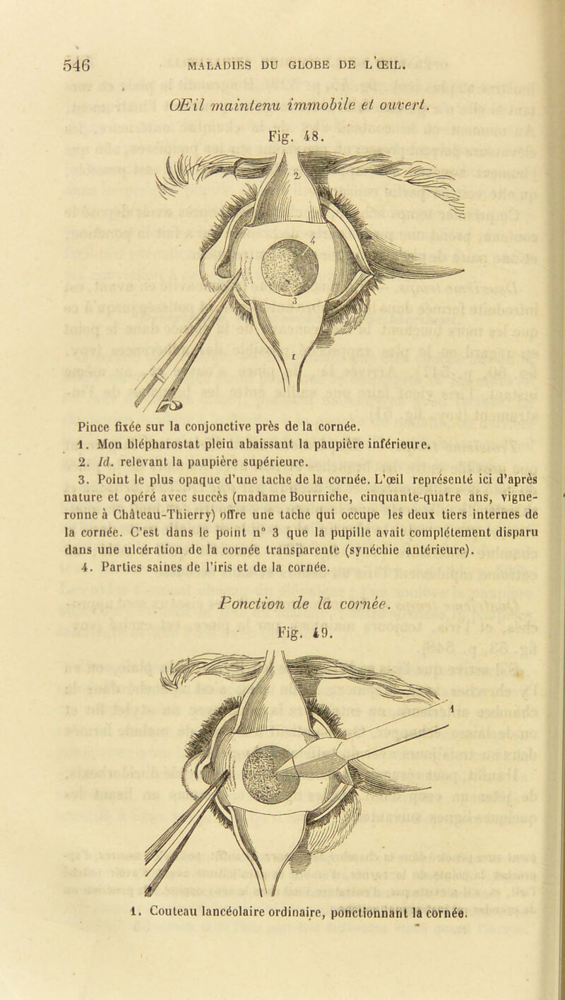 1 Œil maintenu immobile et ouvert. Fig. 48. Pince fixée sur la conjonctive près de la cornée. 1. Mon blépharostat plein abaissant la paupière inférieure. 2. Id. relevant la paupière supérieure. 3. Point le plus opaque d’une tache de la cornée. L’œil représenté ici d’après nature et opéré avec succès (madame Bourniche, cinquante-quatre ans, vigne- ronne à Château-Thierry) offre une tache qui occupe les deux tiers internes de la cornée. C’est dans le point n° 3 que la pupille avait complètement disparu dans une ulcération de la cornée transparente (synéchie antérieure). 4. Parties saines de l’iris et de la cornée. Ponction de la cornée. Fig. 49. 1. Couteau lancéolaire ordinaire, ponctionnant la cornée.